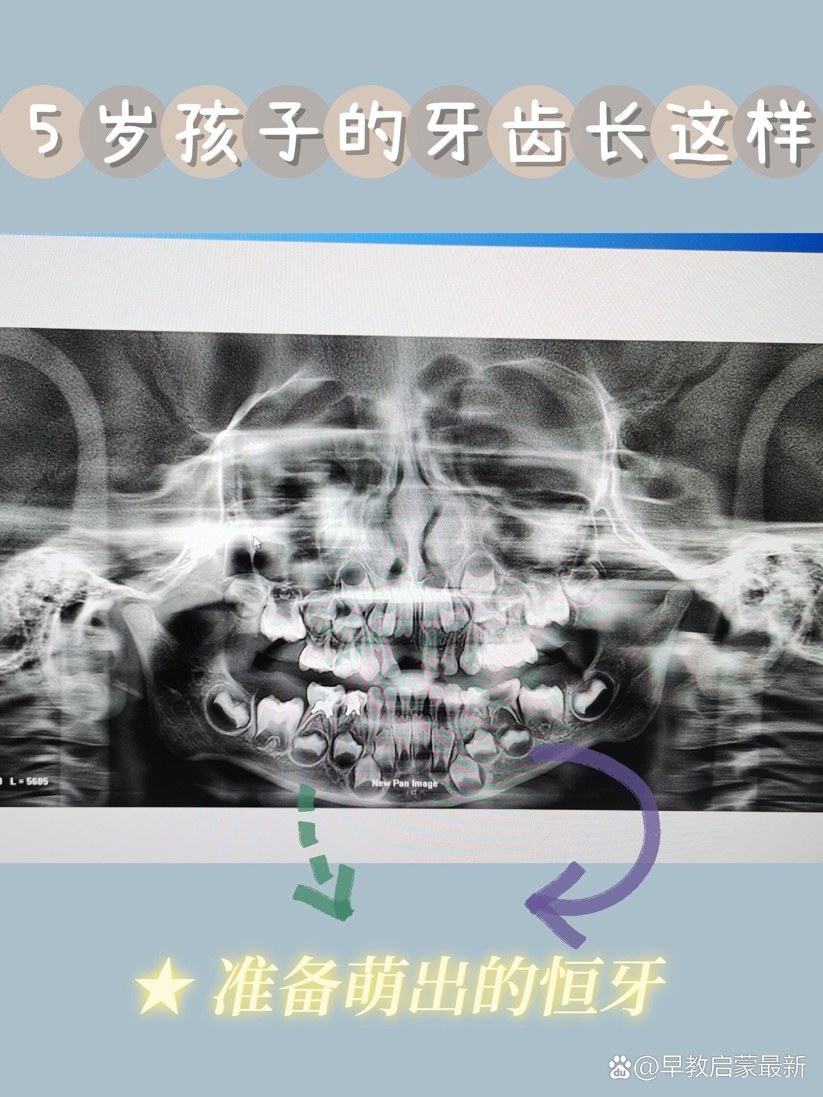 小孩牙齿图片x光图片