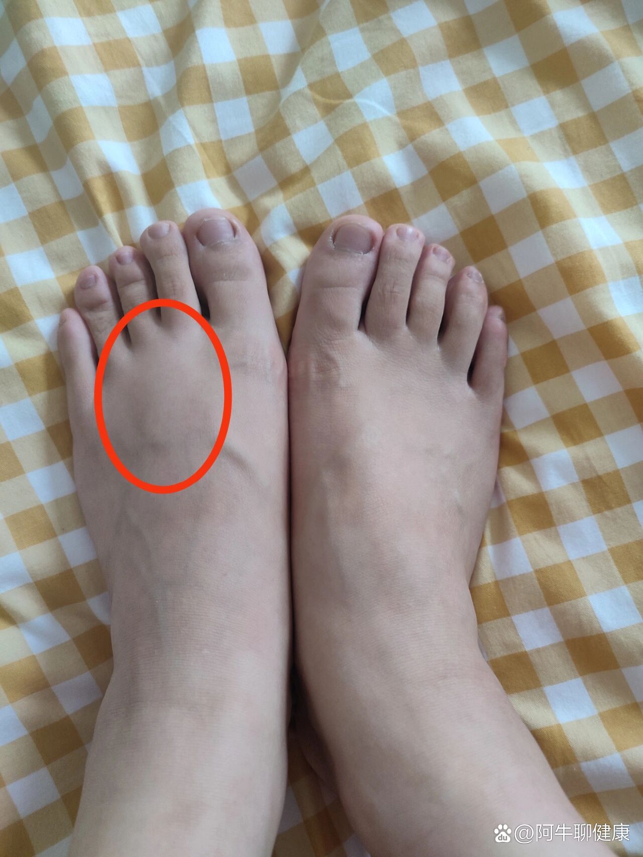 跳绳后脚背肿了
