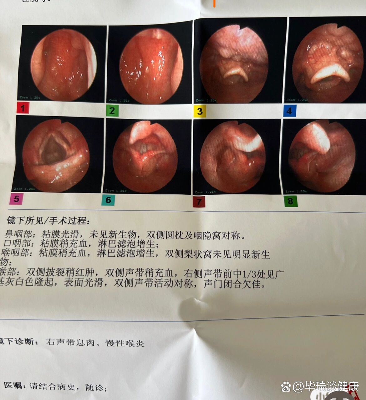 喉镜鼻咽镜慢性喉炎