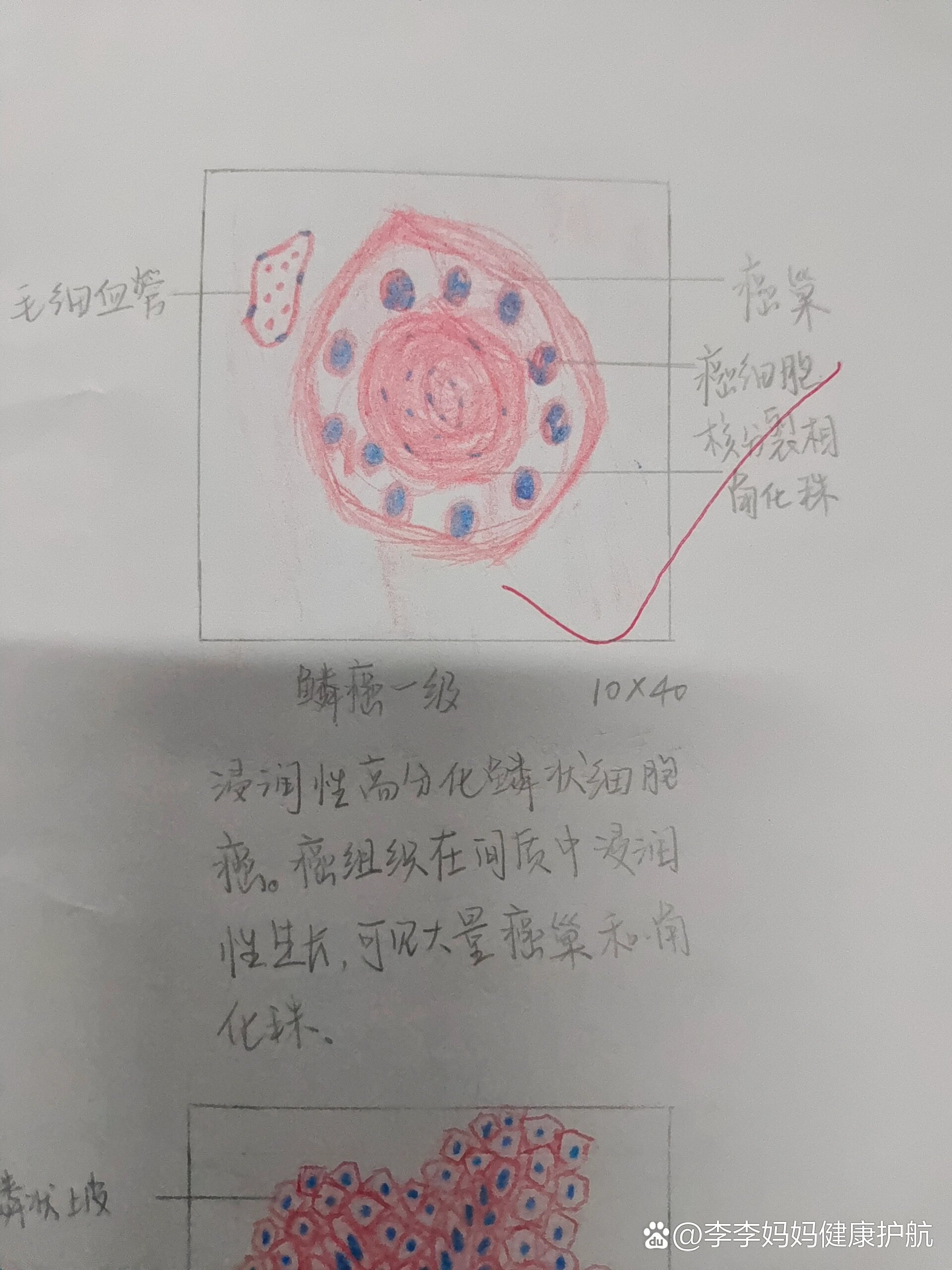 绒毛膜癌病理手绘图图片