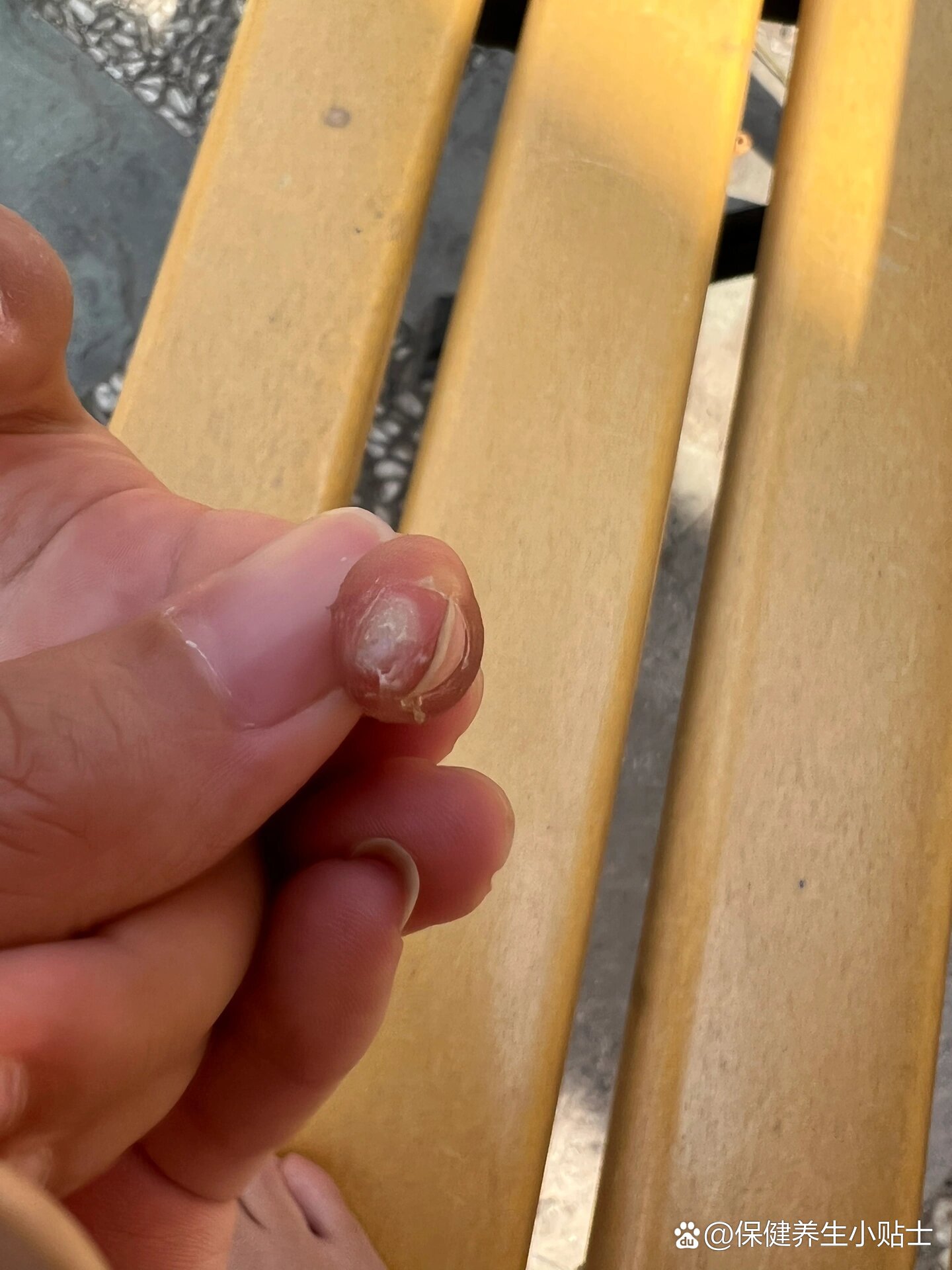 儿童甲周疣终于好了,太难了