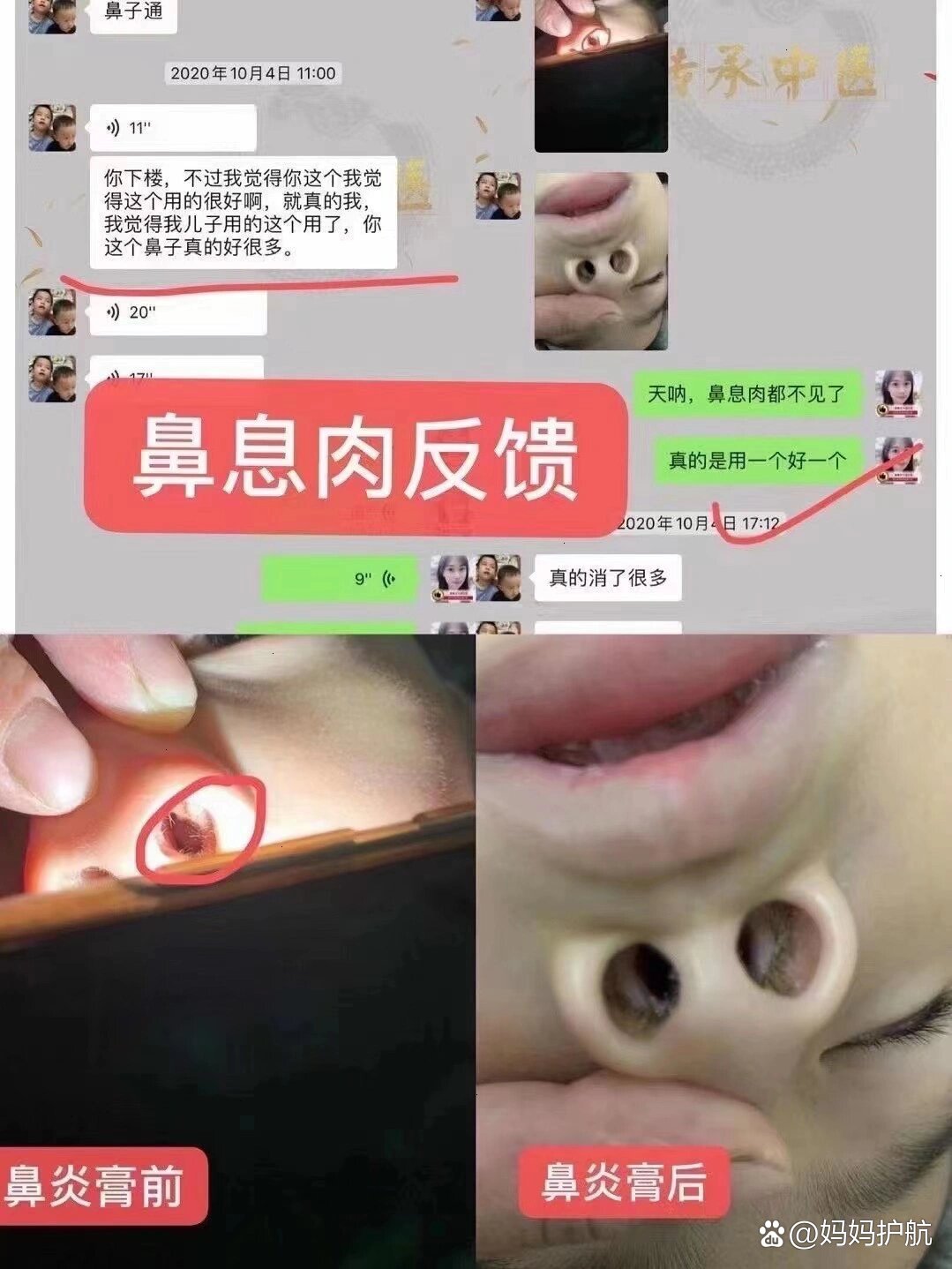 小孩鼻息肉怎样治疗图片