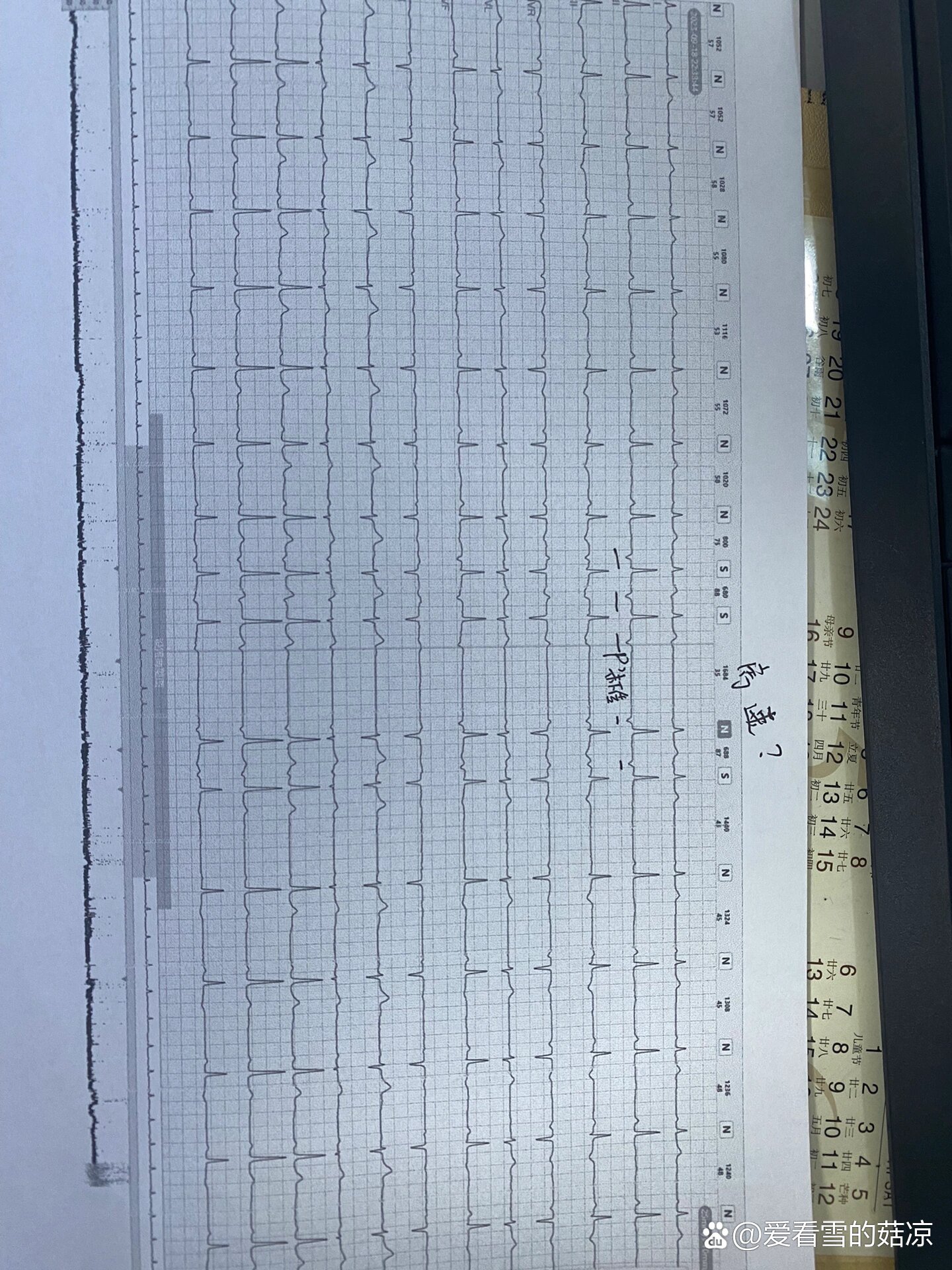 房速伴文氏传导伴传出阻滞