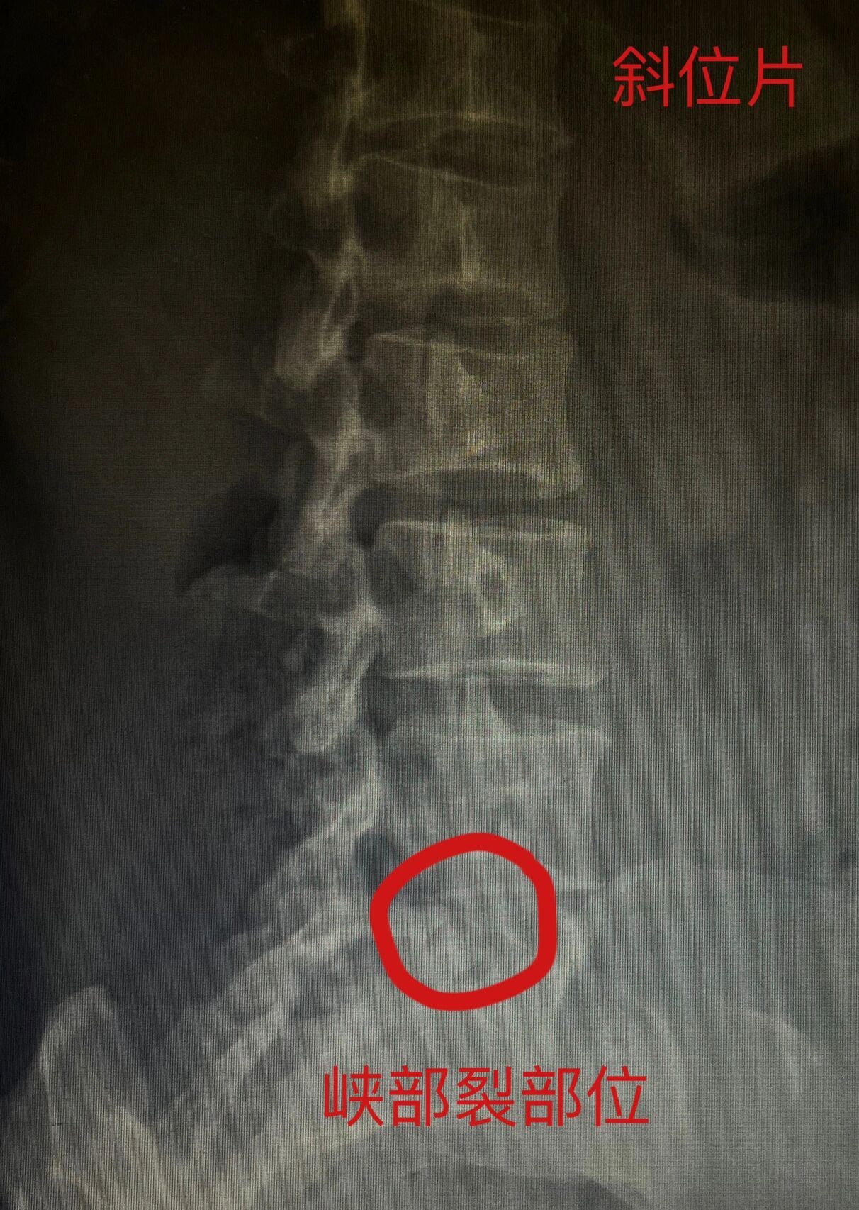 年轻患者腰椎峡部裂该如何治疗?