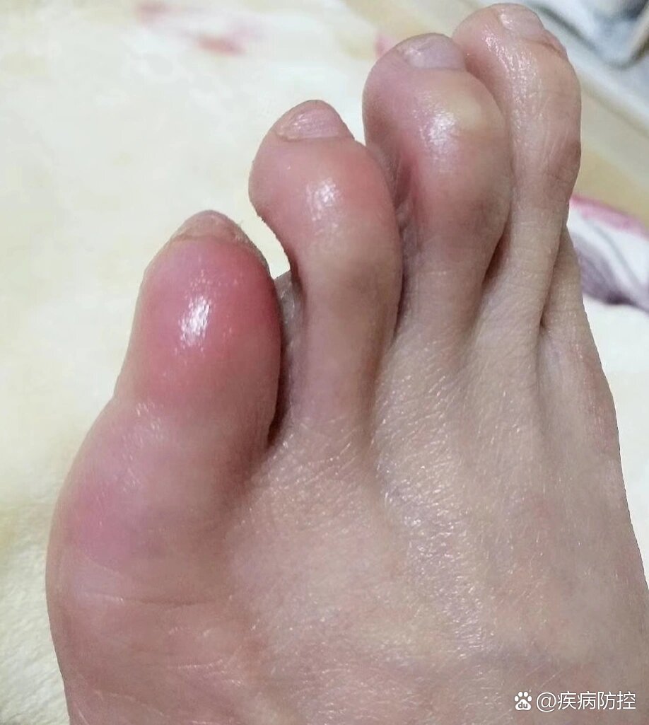 年年冻脚,有木有好方法,再也不冻了
