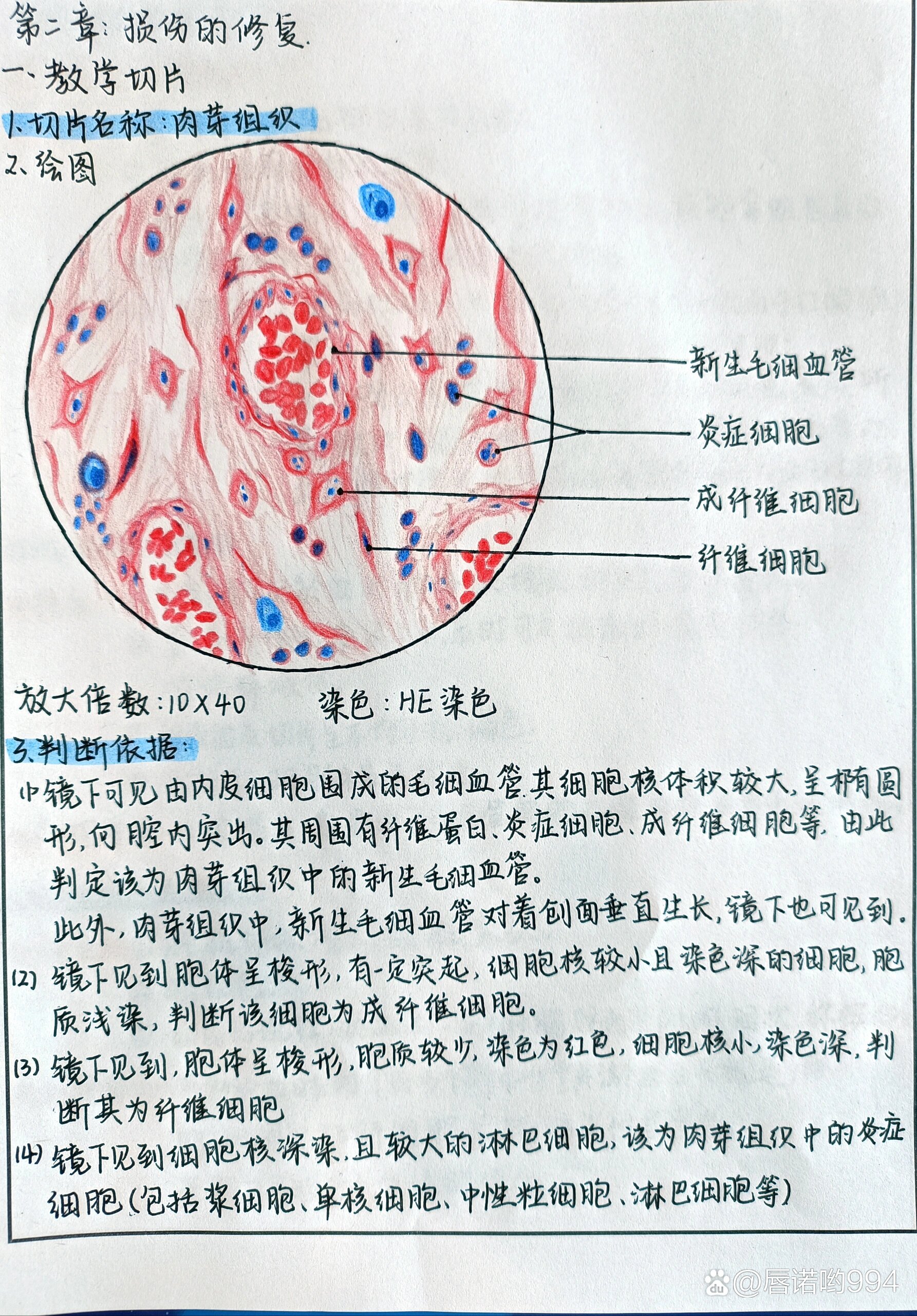 绒毛膜癌病理手绘图图片