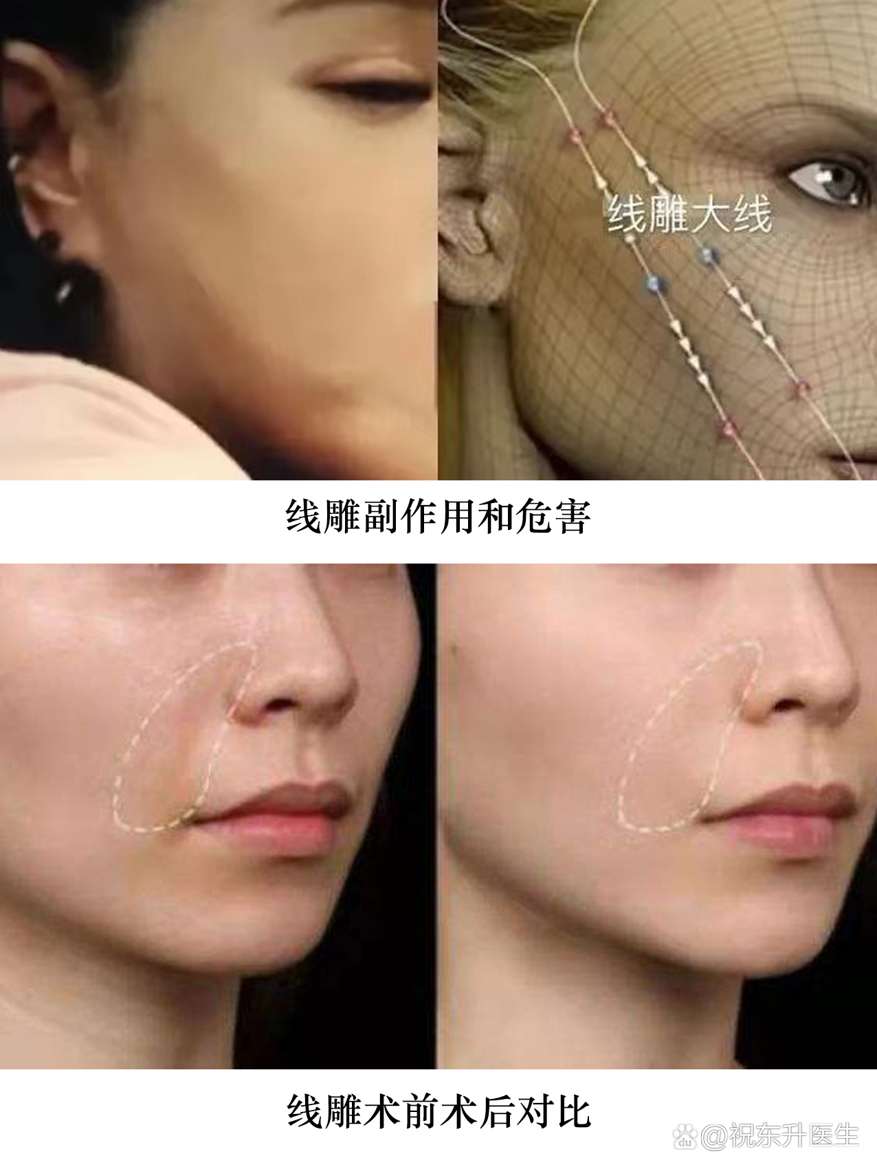 线雕的副作用和危害有哪些?