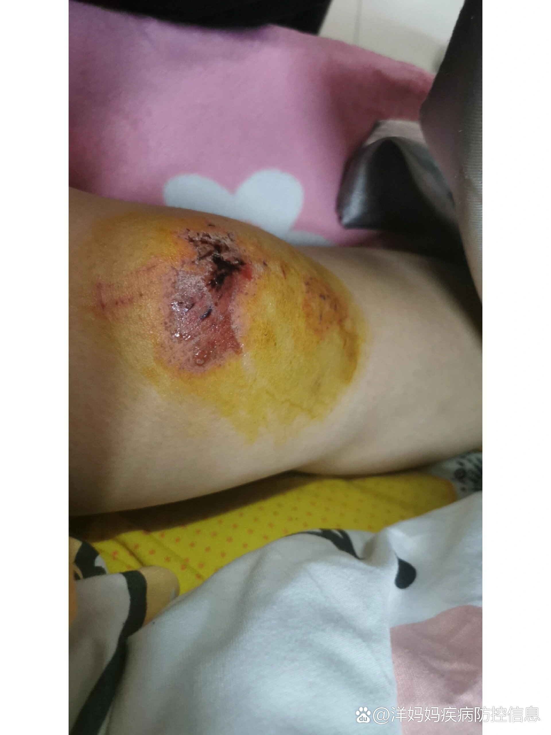 骑电动车膝盖摔伤第6天01慎点