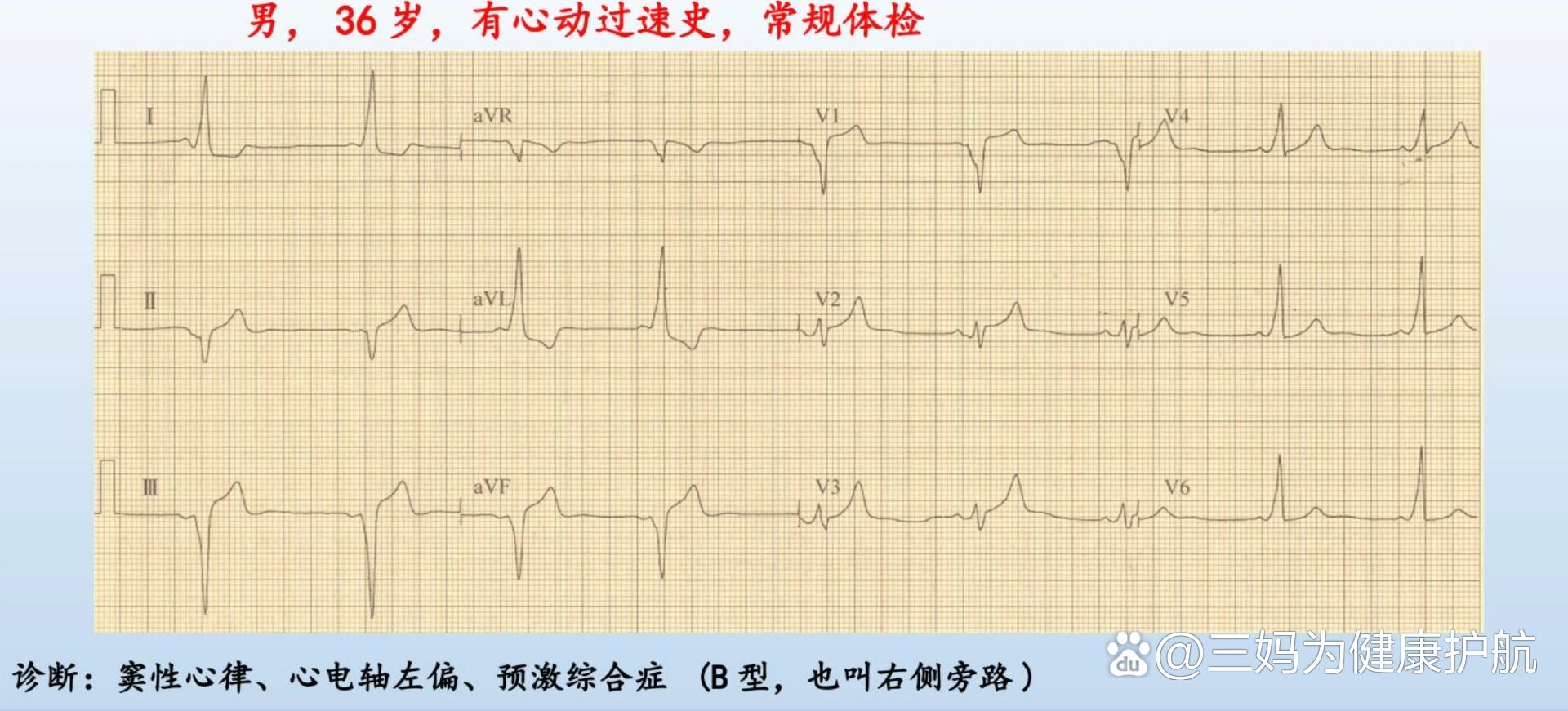 两招识别预激综合征心电图