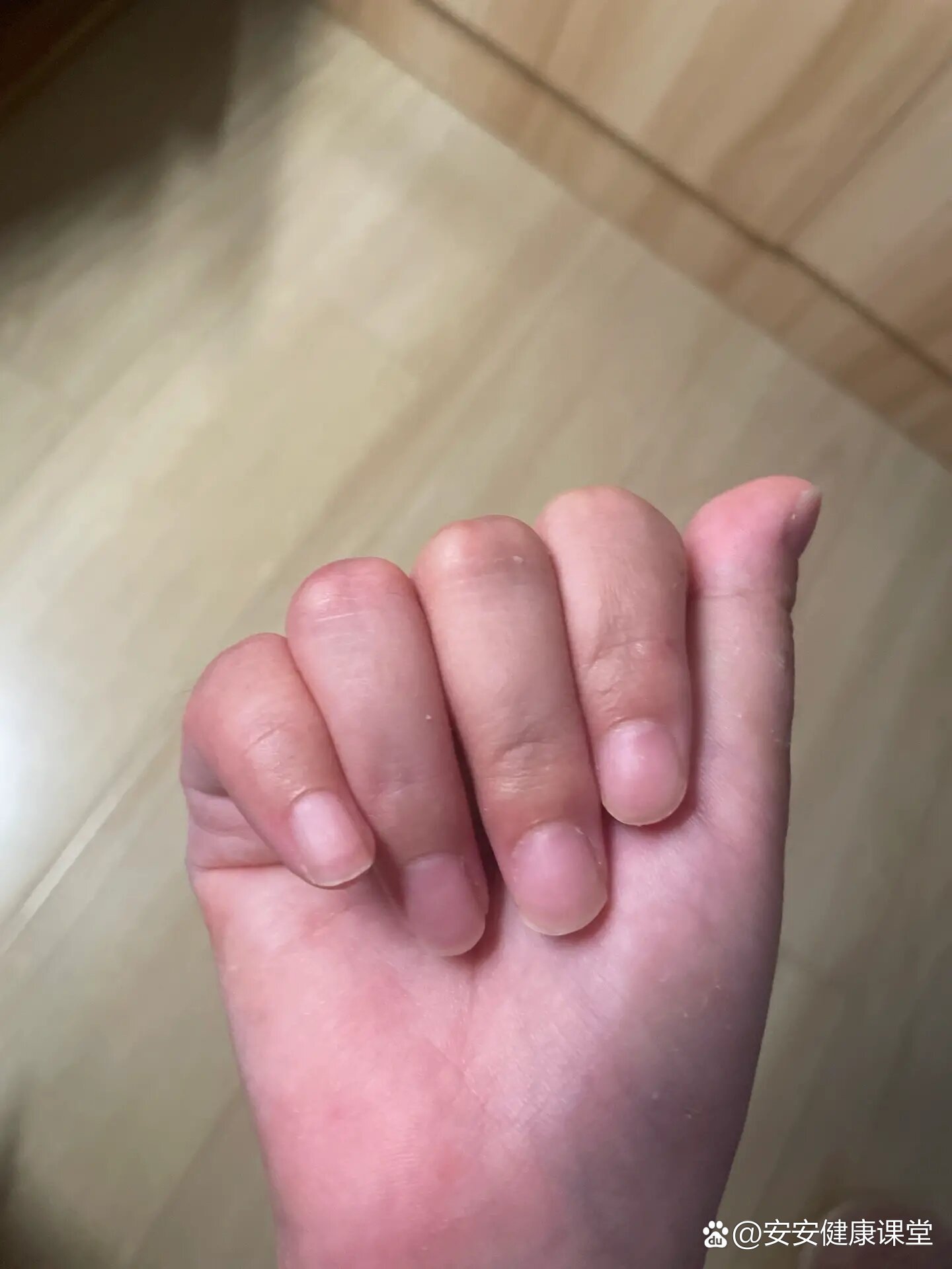掌骨骨折后手指歪了