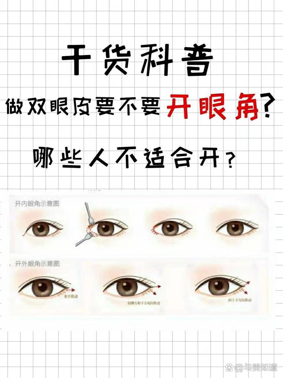 割双眼皮一定要开眼角吗?