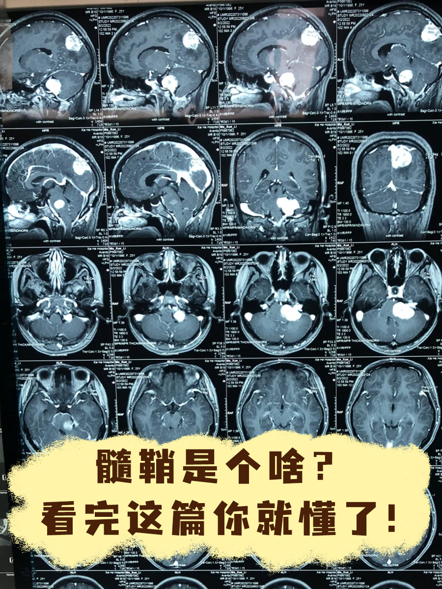 髓鞘是个啥?看完这篇你就懂了!
