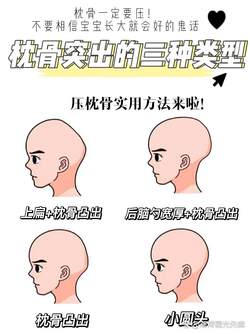 枕骨凸出的三种类型