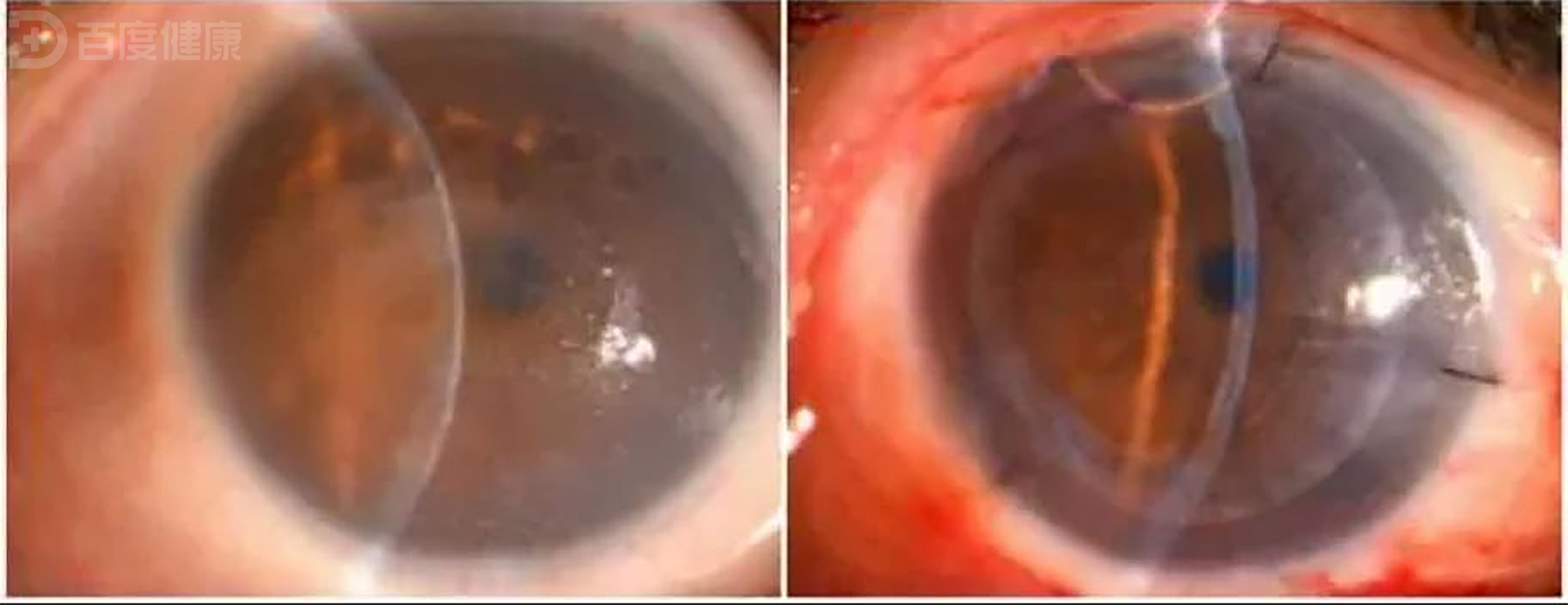 眼皮水肿一周未在意,经检查确诊为角膜内皮营养不良