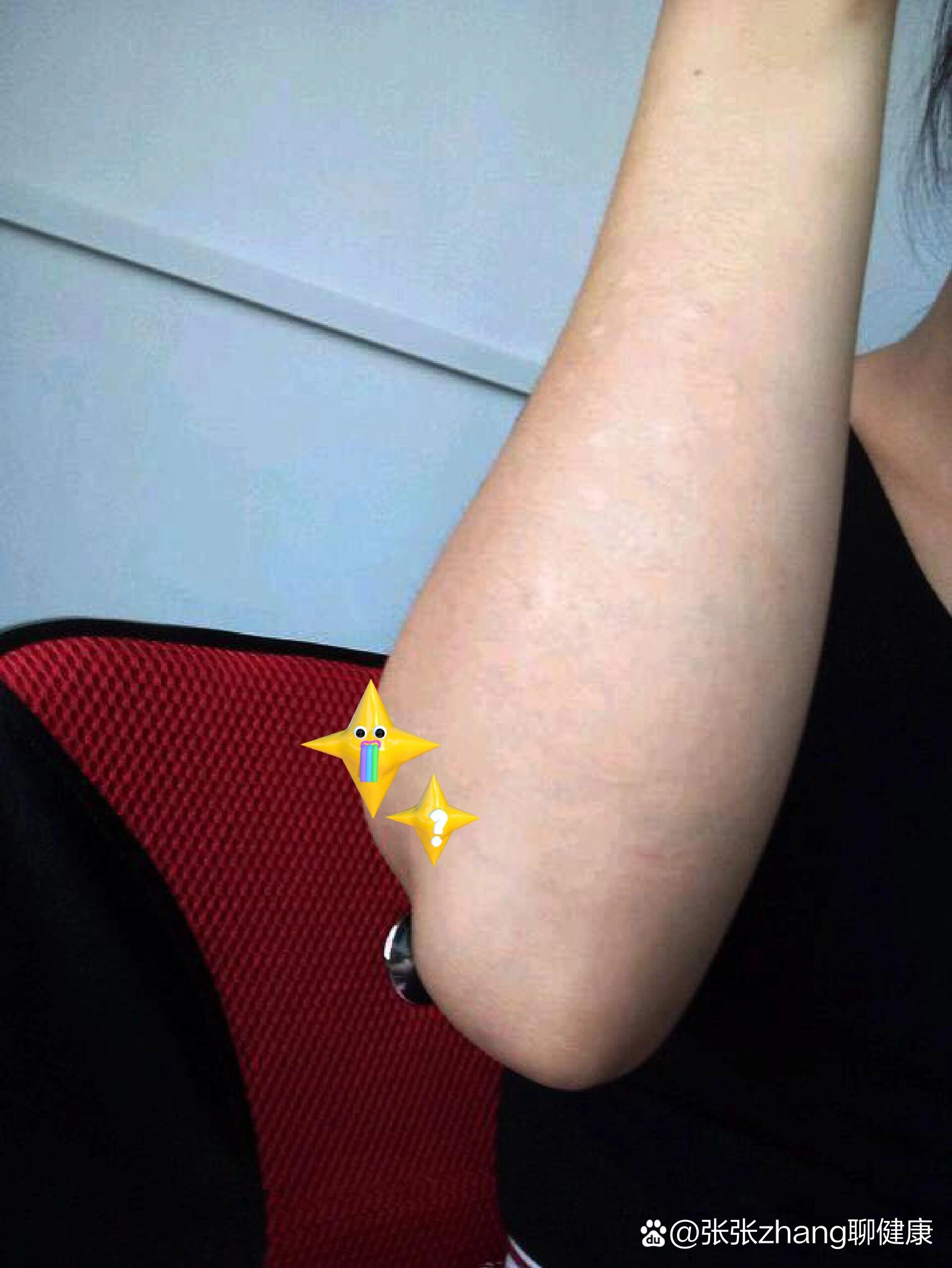 手肘牛皮癣,一个冬季两个月,没复发过