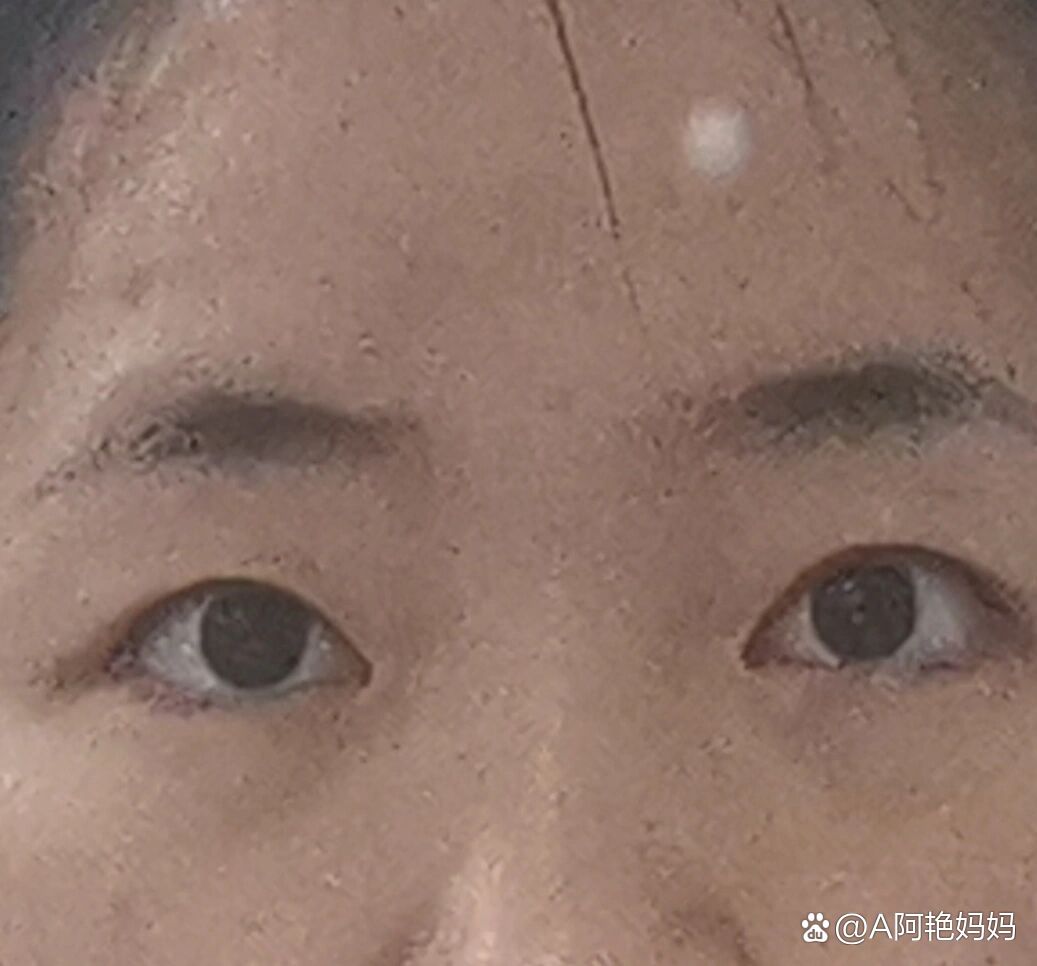 的评论,有人会问我这个问题,既然能帮到大家,就说说吧,我是先天性斜视