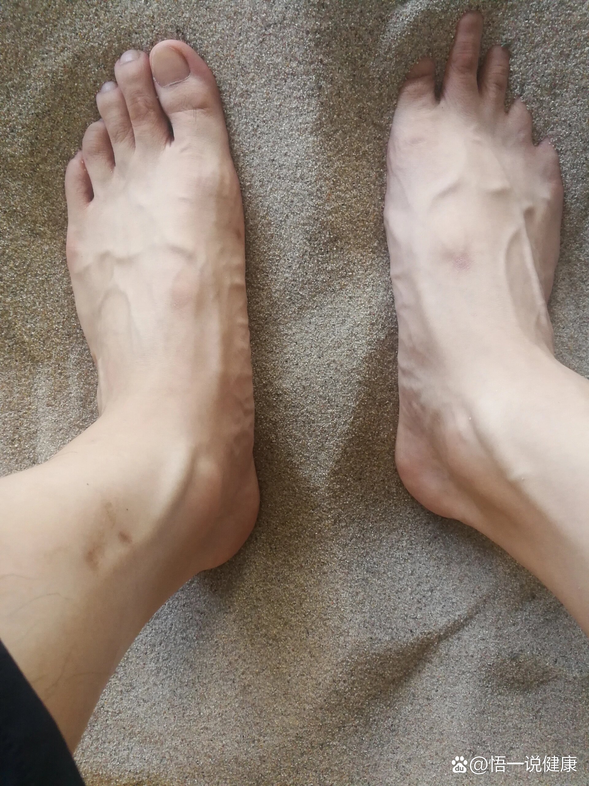 脚踝处血管特别突出正常么