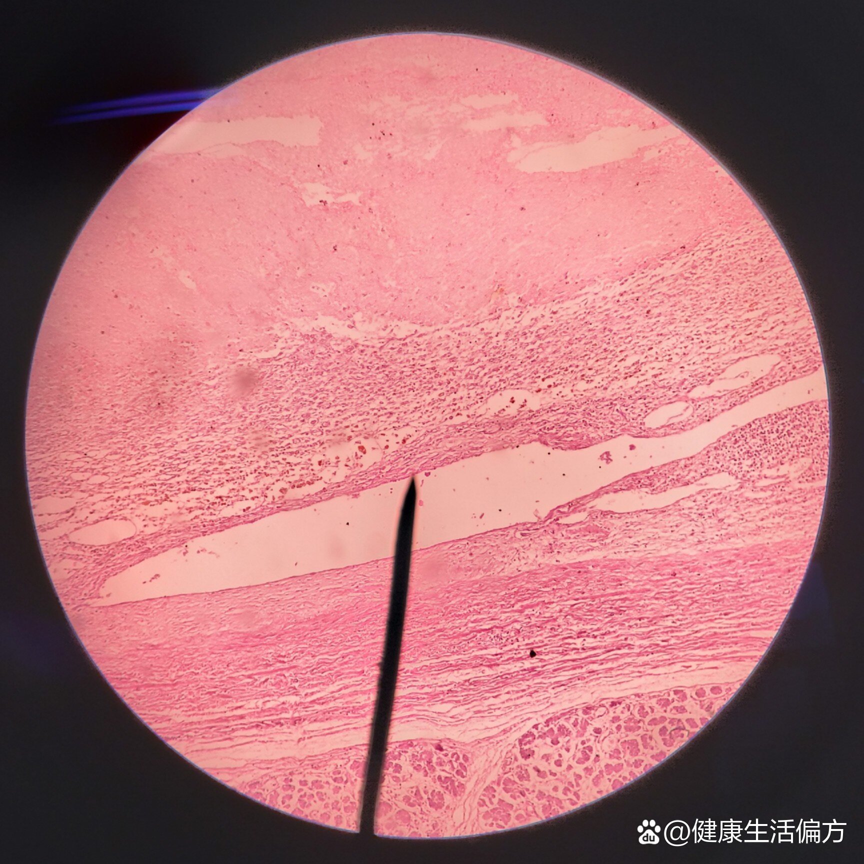 病理学切片-血栓机化与再通,慢性肺淤血