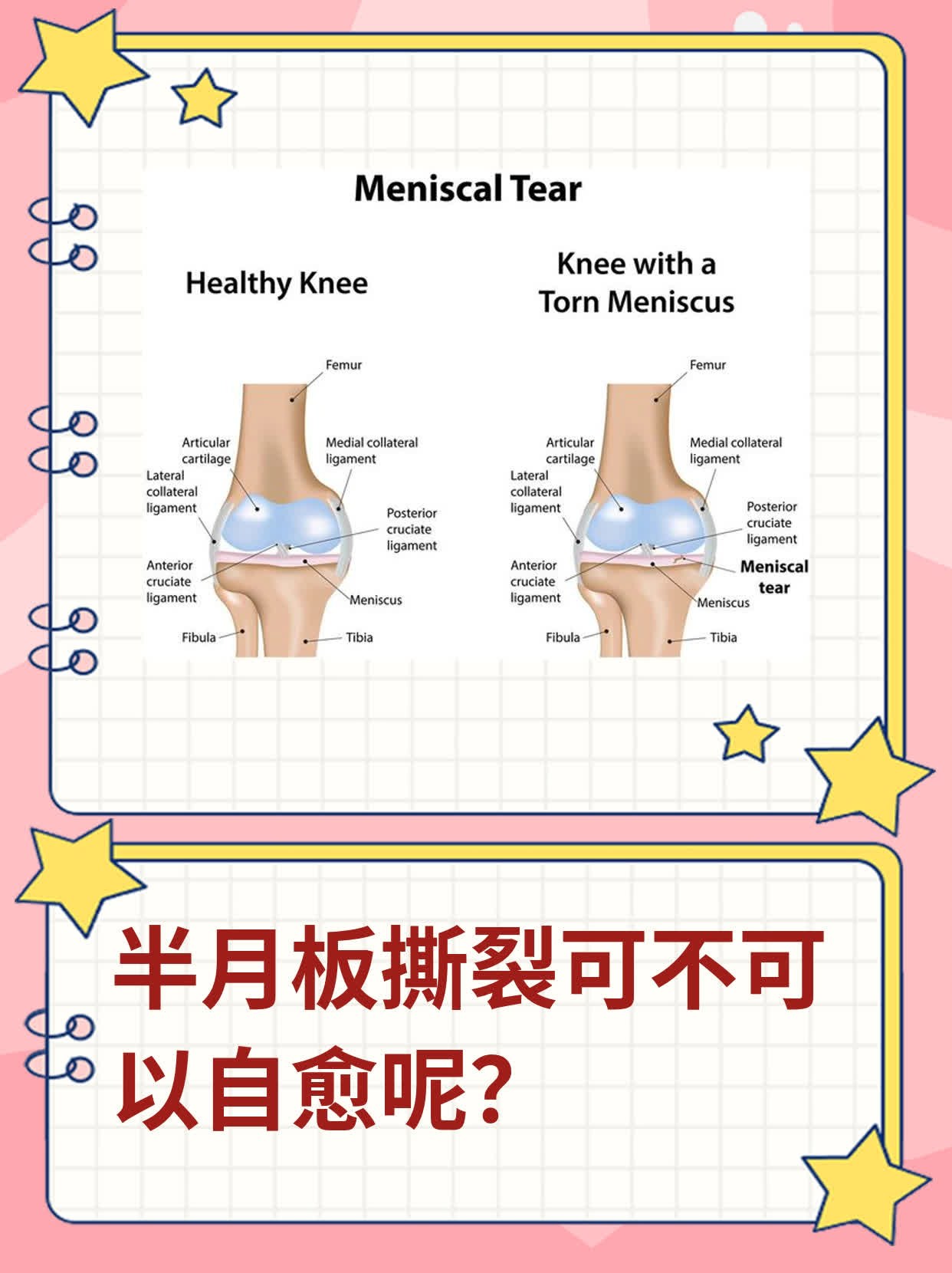 半月板撕裂可不可以自愈呢