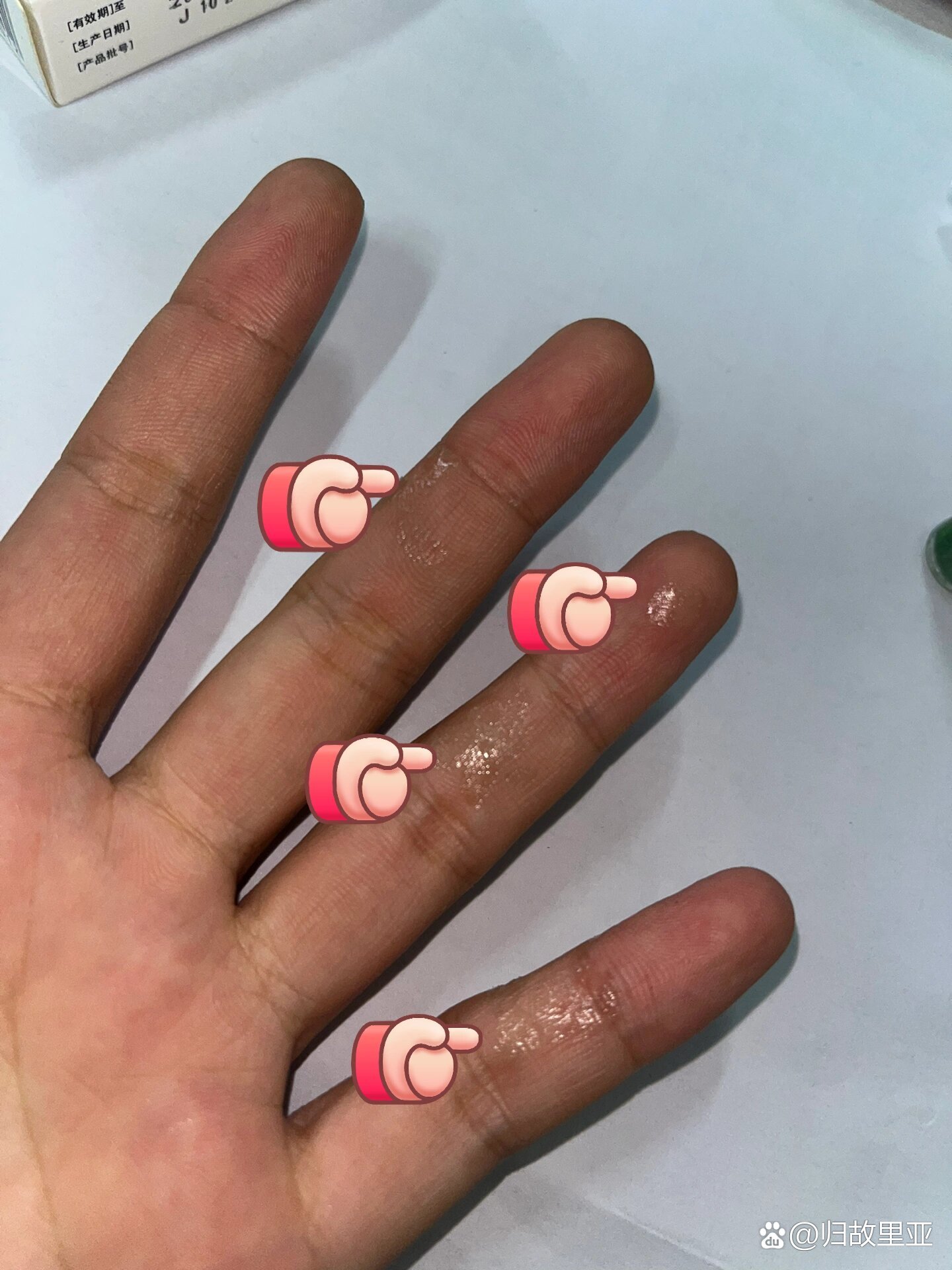 皮肤粘到502胶水怎么办?