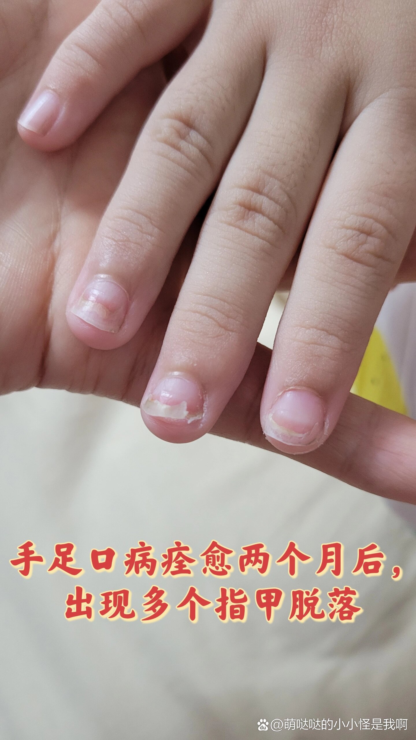 宝宝手足口病后遗症