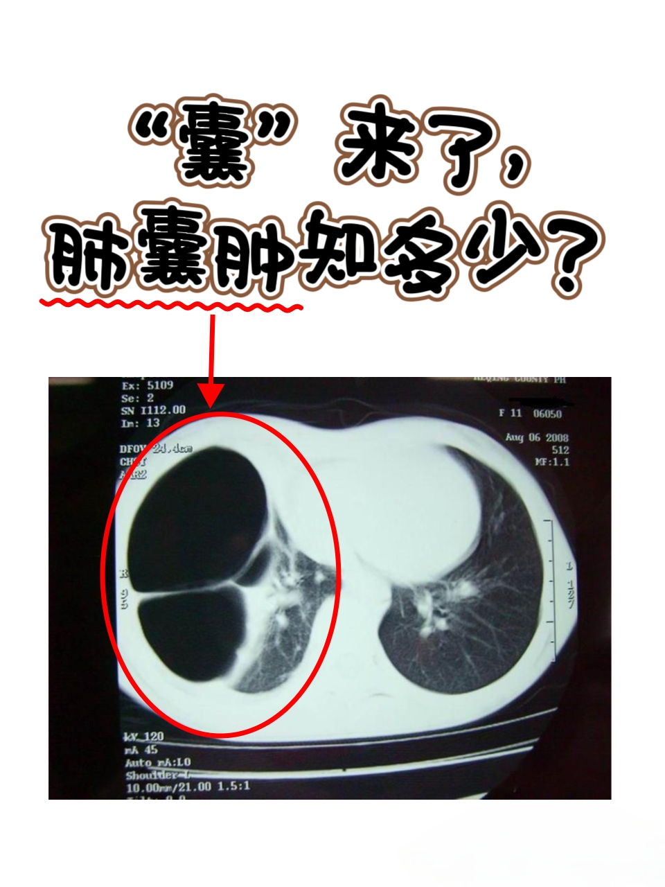 前段时间接诊了一位患者,在进行ct检查的时候,发现他的肺部有囊肿
