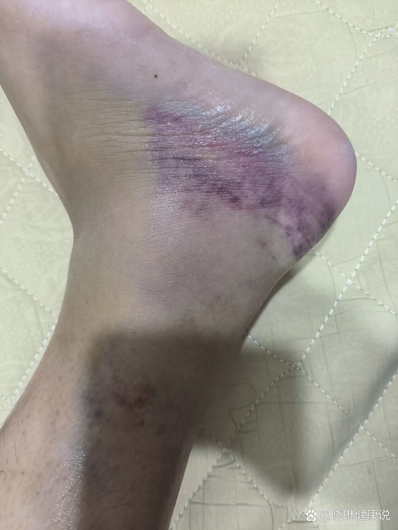 崴脚10天肿消的差不多了,一直自粘绷带固定,现在淤青转移,上
