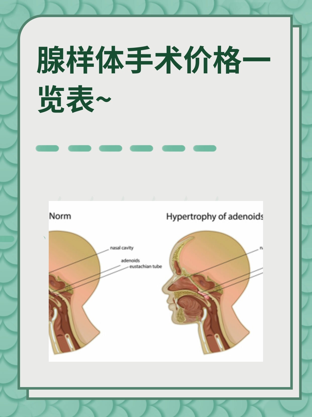 孩子因为腺样体肥大,最近睡眠质量很差,我想知道手术的费用是多少