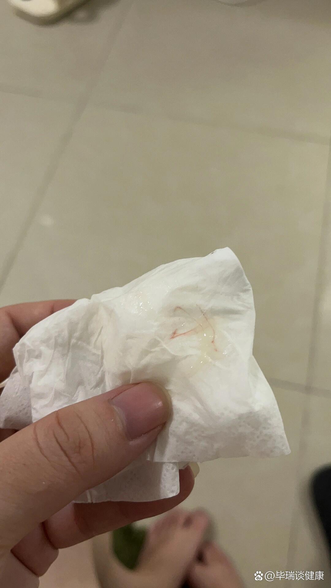 有血丝需要去医院嘛想问下姐妹们35周有一点点血丝这种是要生了嘛