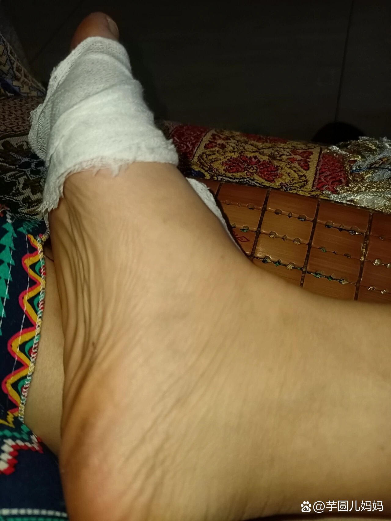 第五趾骨小脚趾骨折之康复篇