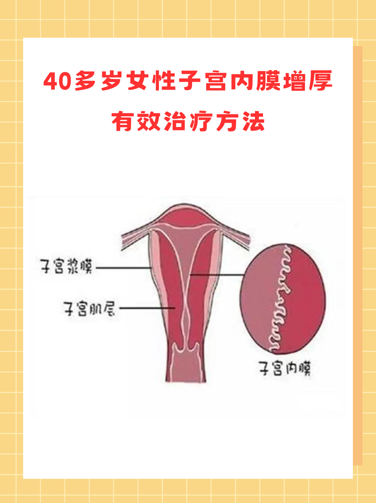 子宫内膜增厚的原因图片