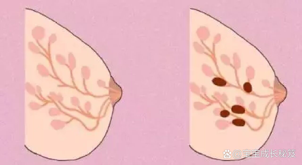 区分乳腺增生和乳腺结节