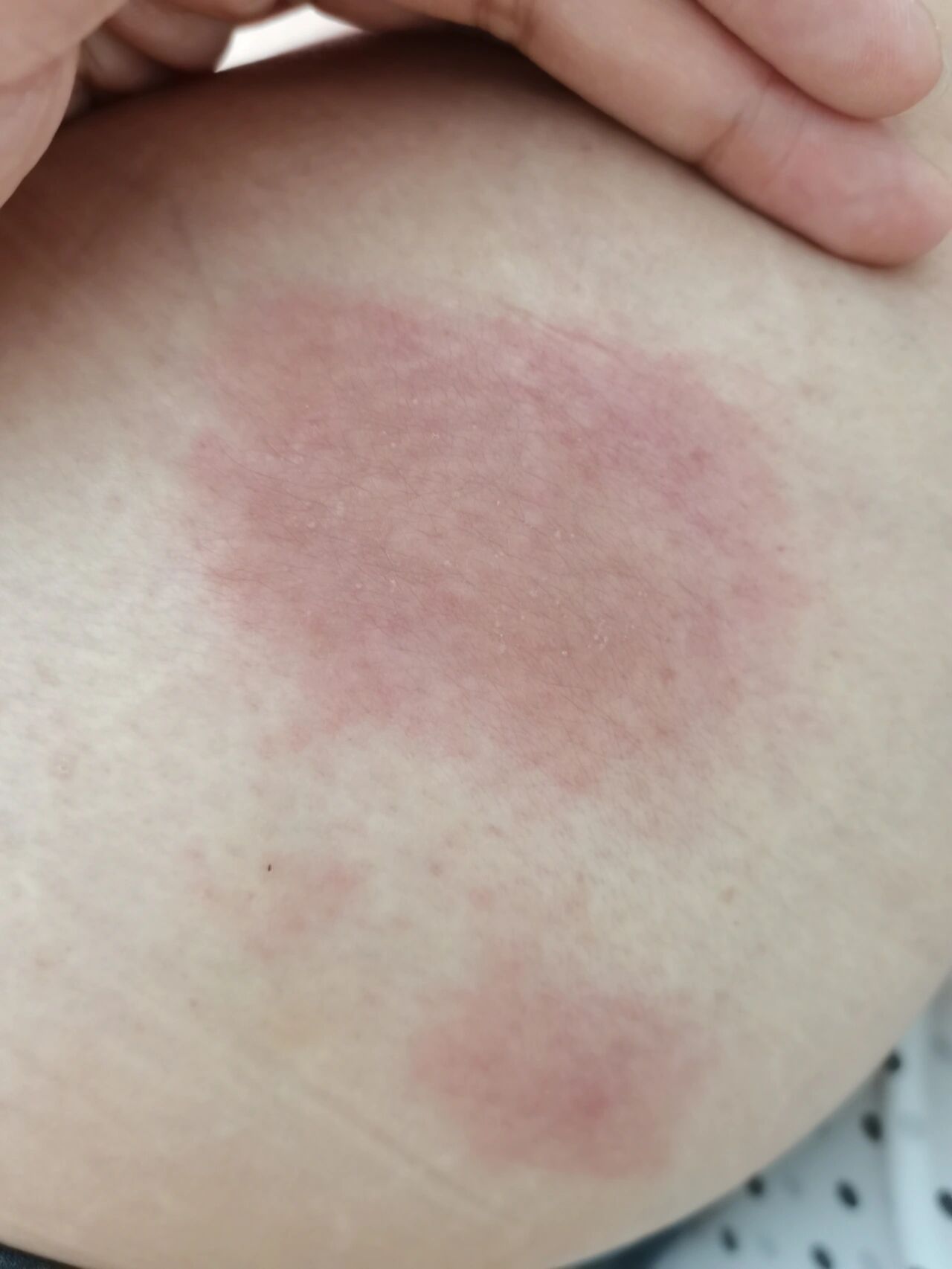 皮肤红红的一片