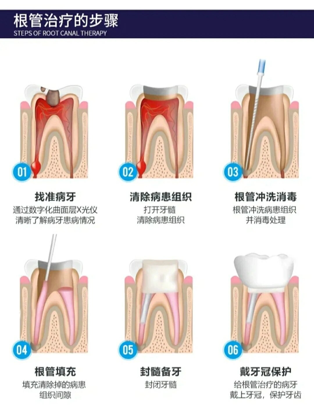 牙齿根管治疗步骤图图片