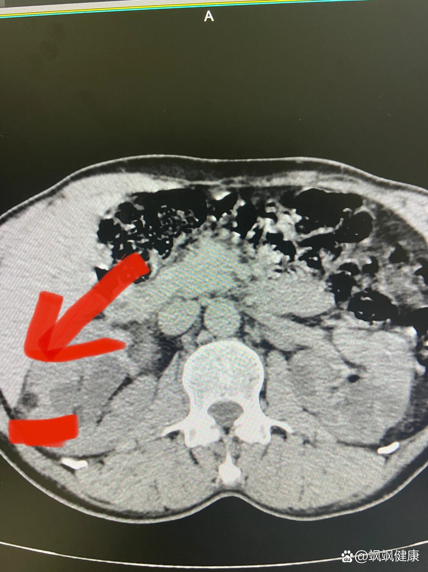 肾部错构瘤图图片