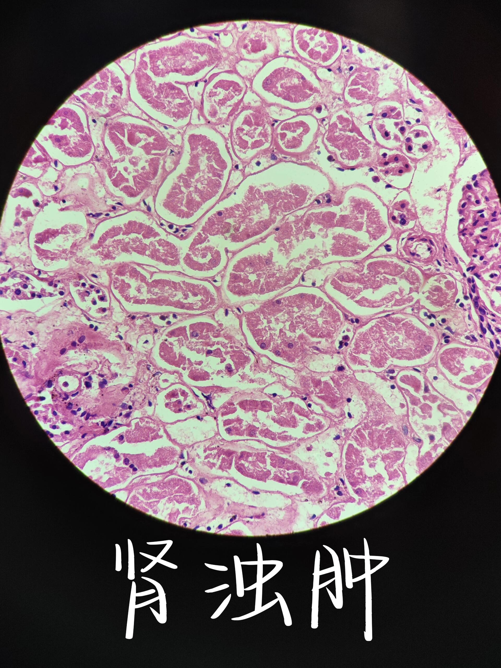 肾浊肿肝脂肪变性结缔组织玻璃样变