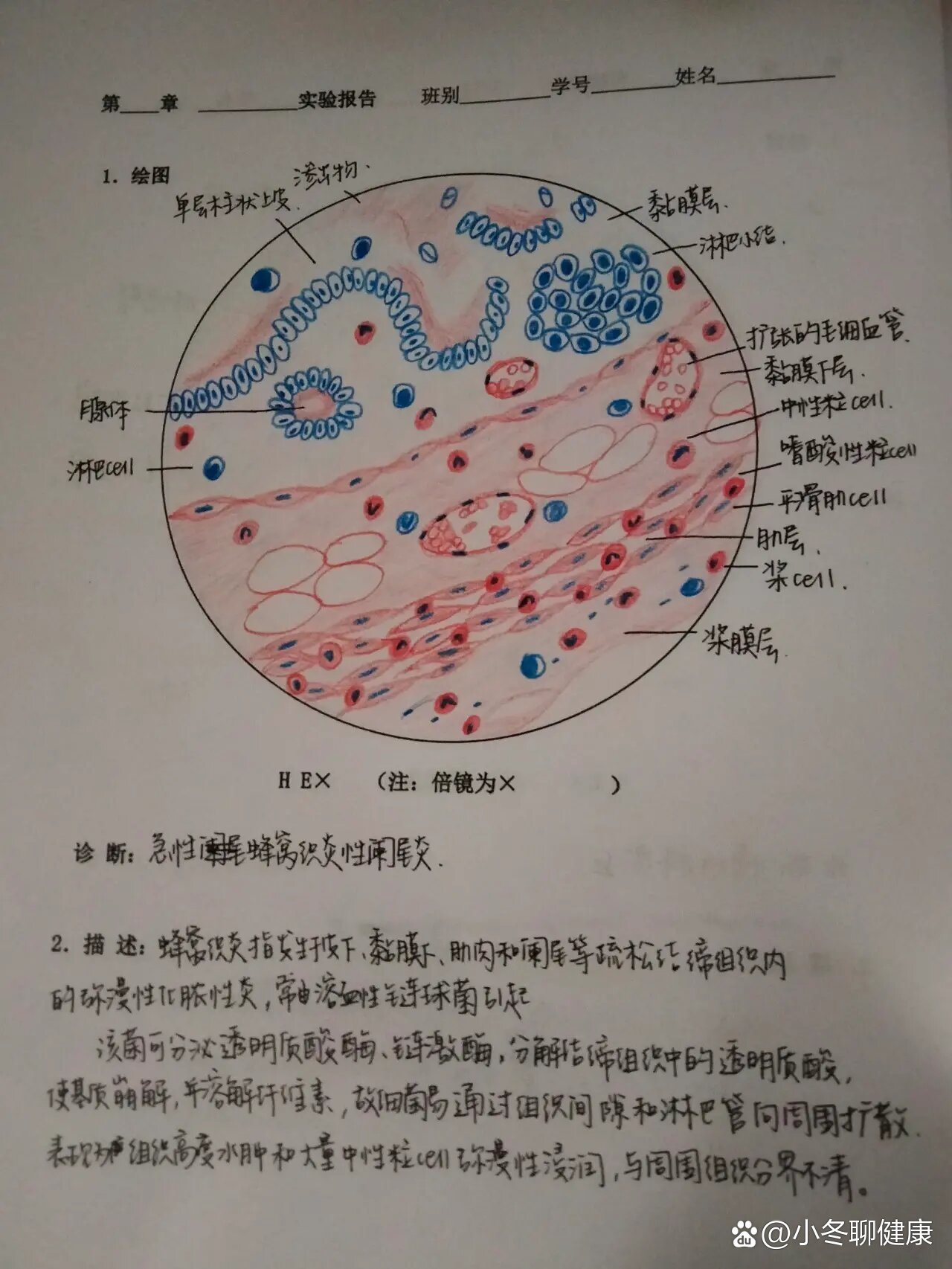 病理实验阑尾炎手绘图图片