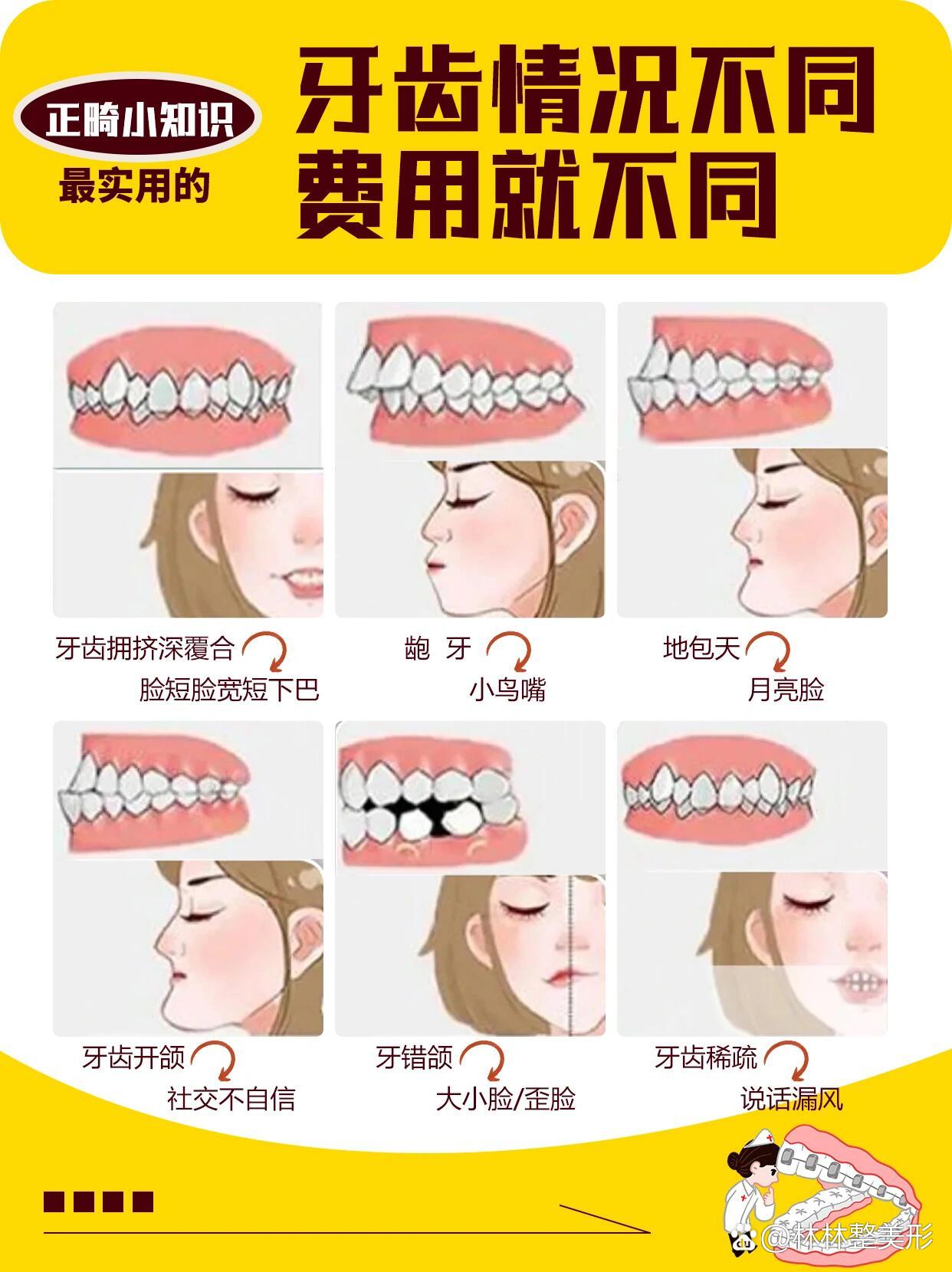 矫正牙齿大概多少钱图片