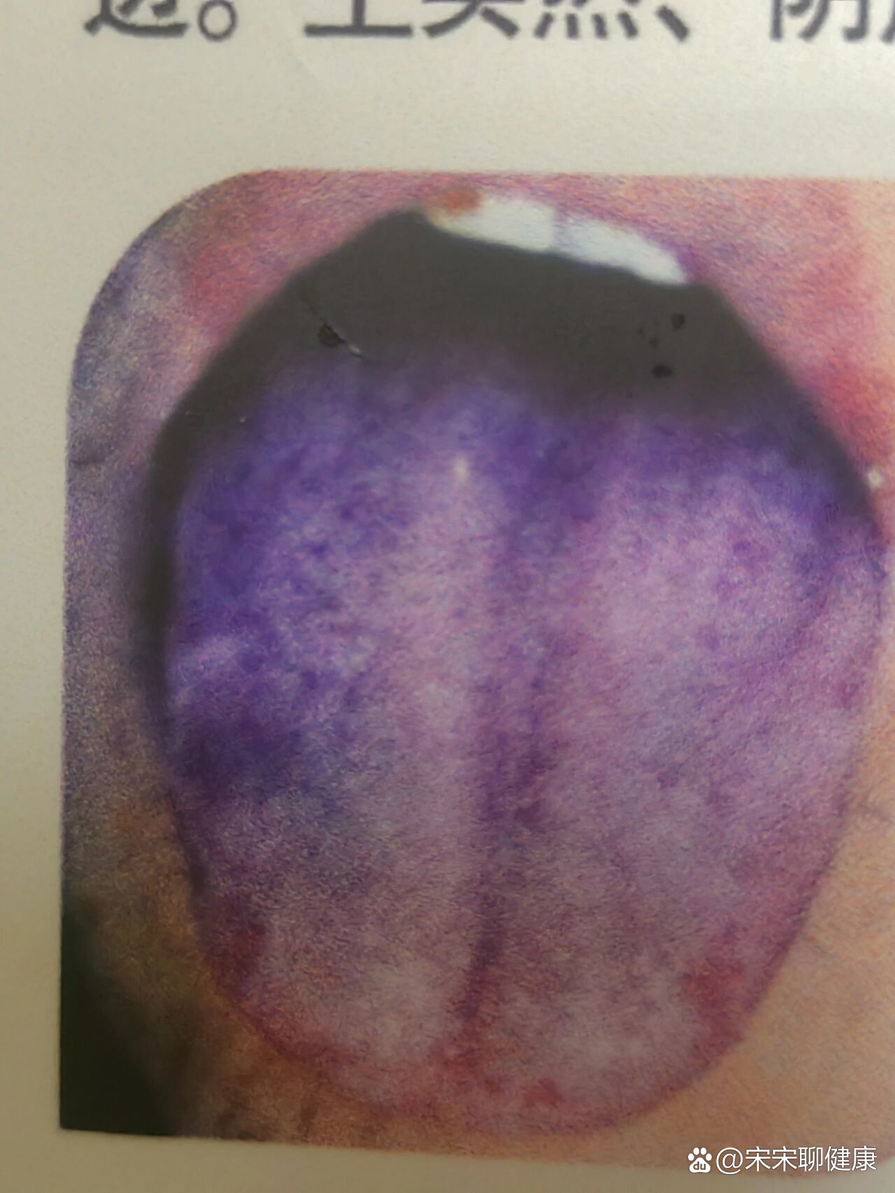 中医基础舌像十一(青紫舌)