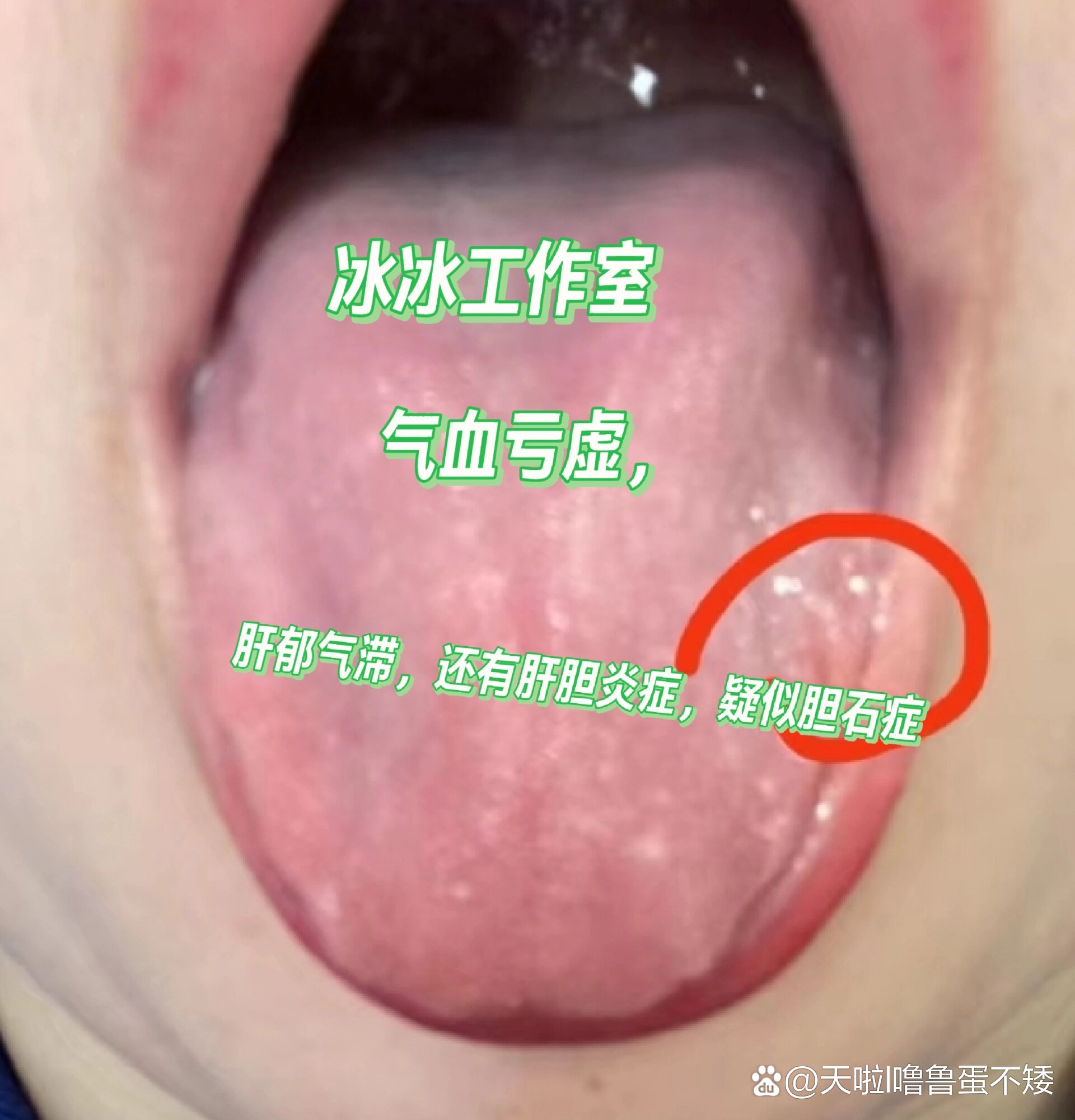 舌诊案例分享科普女:32岁胆结石舌像