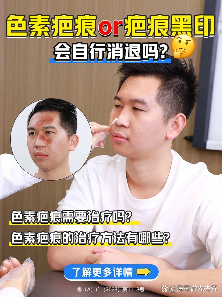 p>色素疤痕会自行消退吗?要不要治疗?