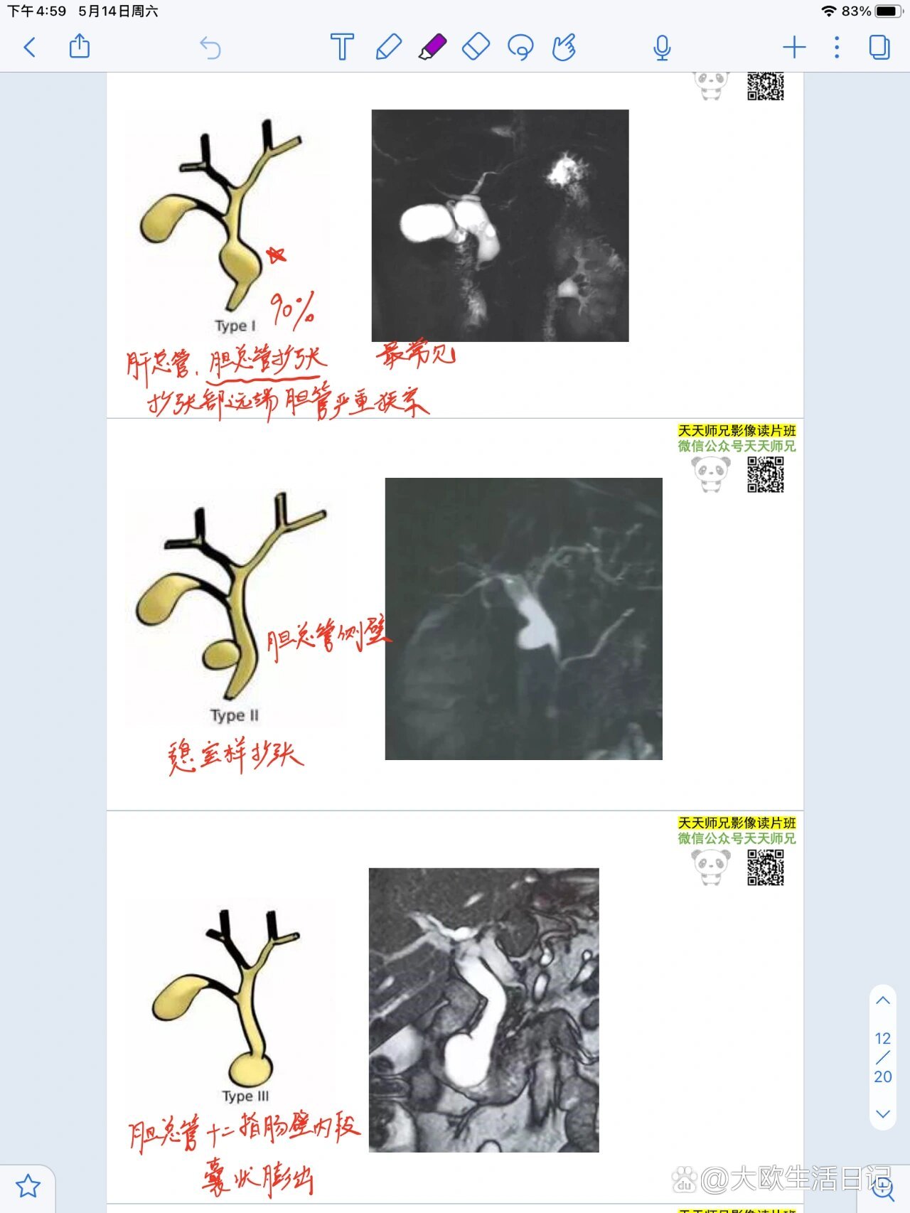 先天性胆管扩张的五种类型