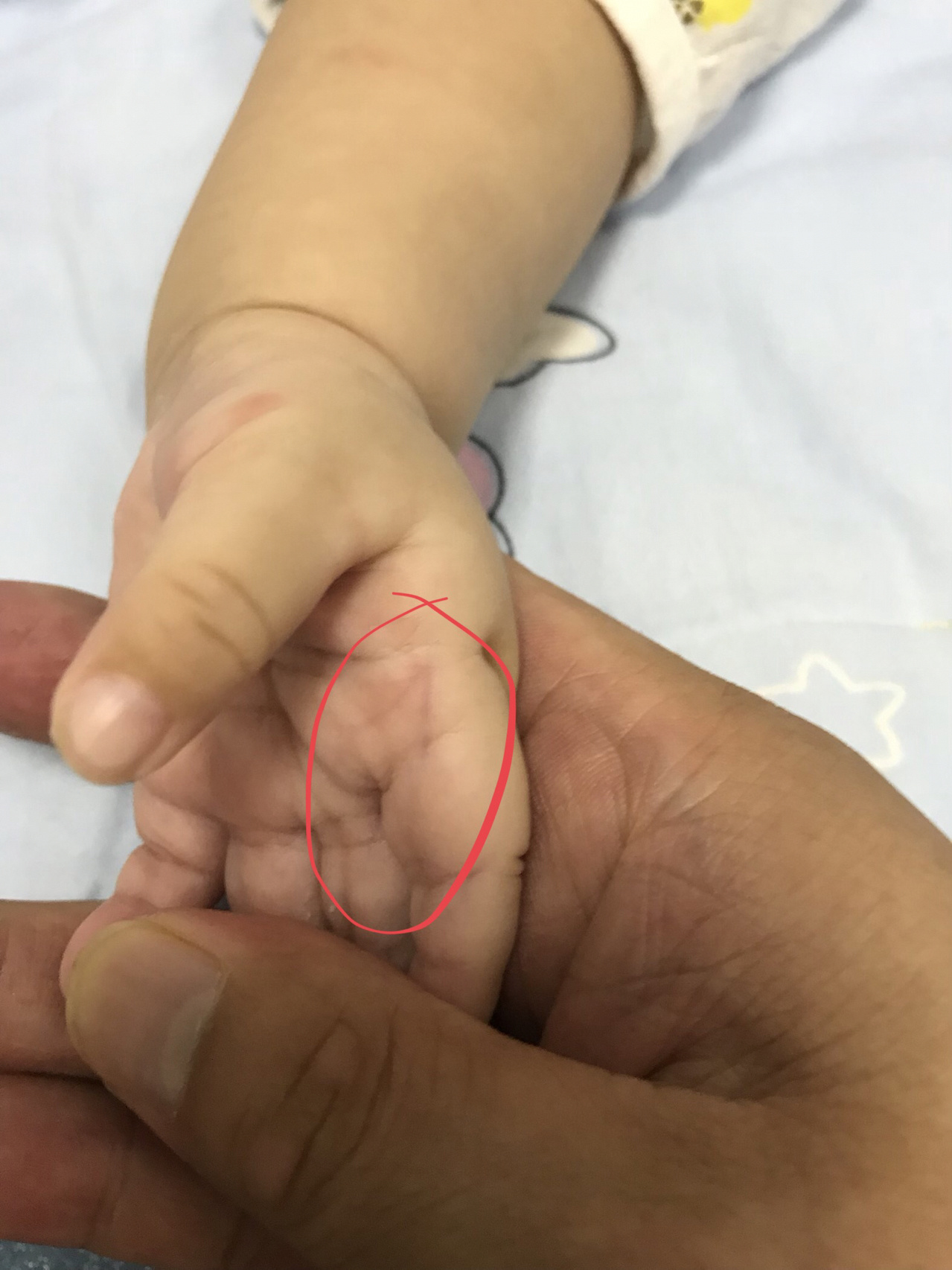 小儿指纹色紫红,家长要当心