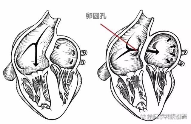 考研/运动解剖/卵圆窝