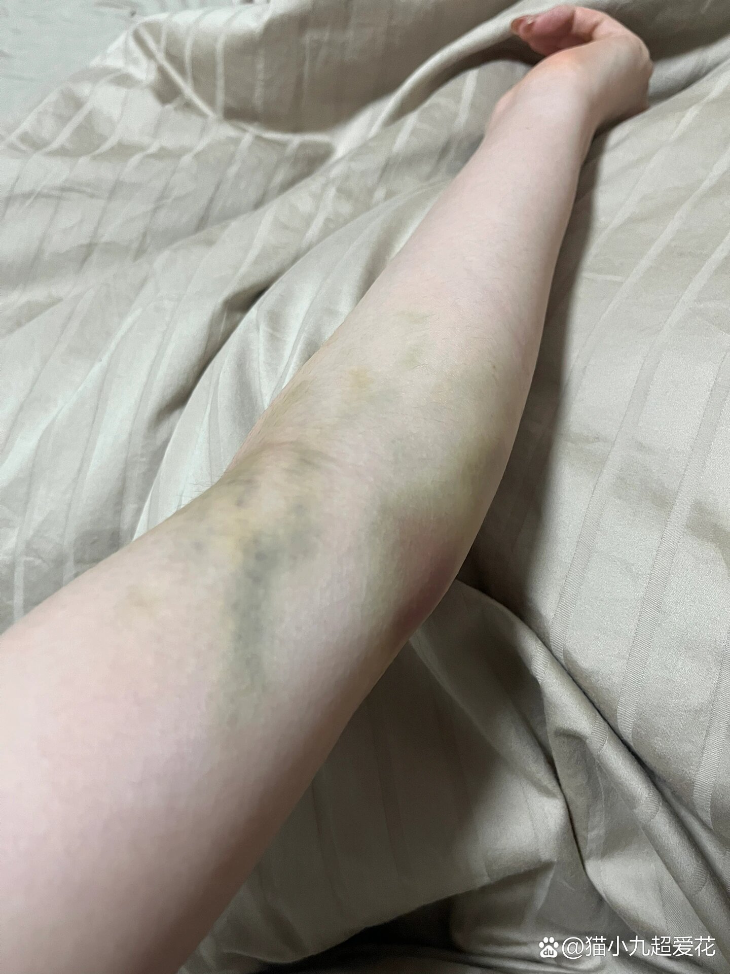 抽血淤青一周了