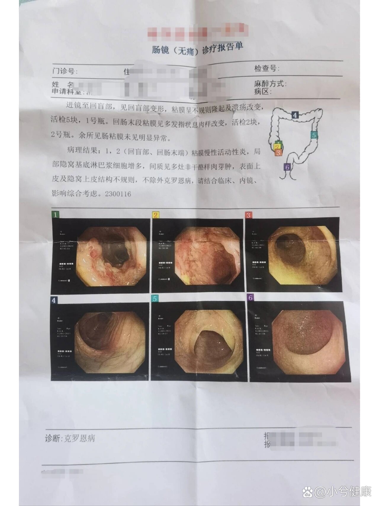 回盲部多发憩室图片