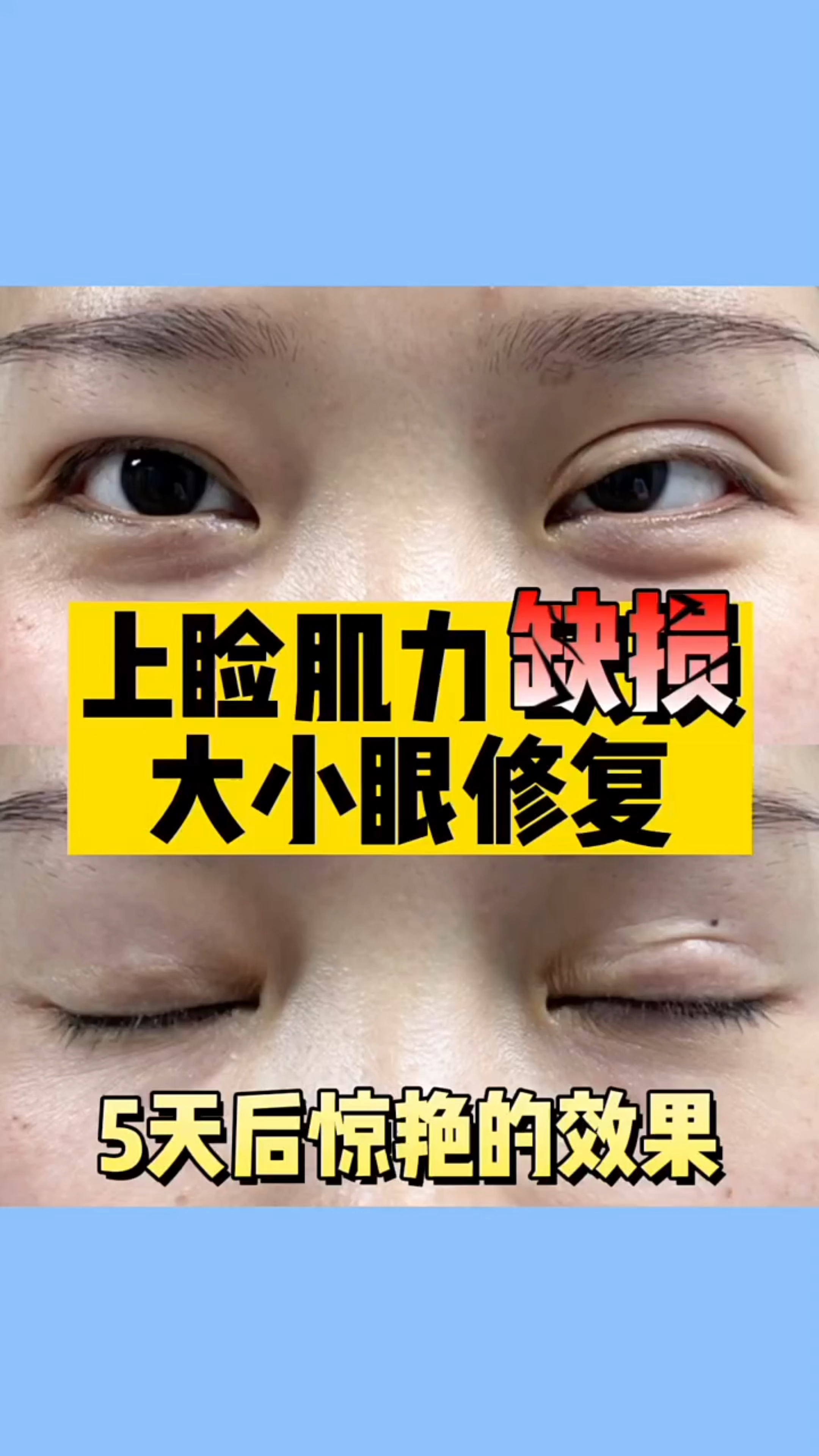 双眼皮上睑肌力缺损,大小眼修复