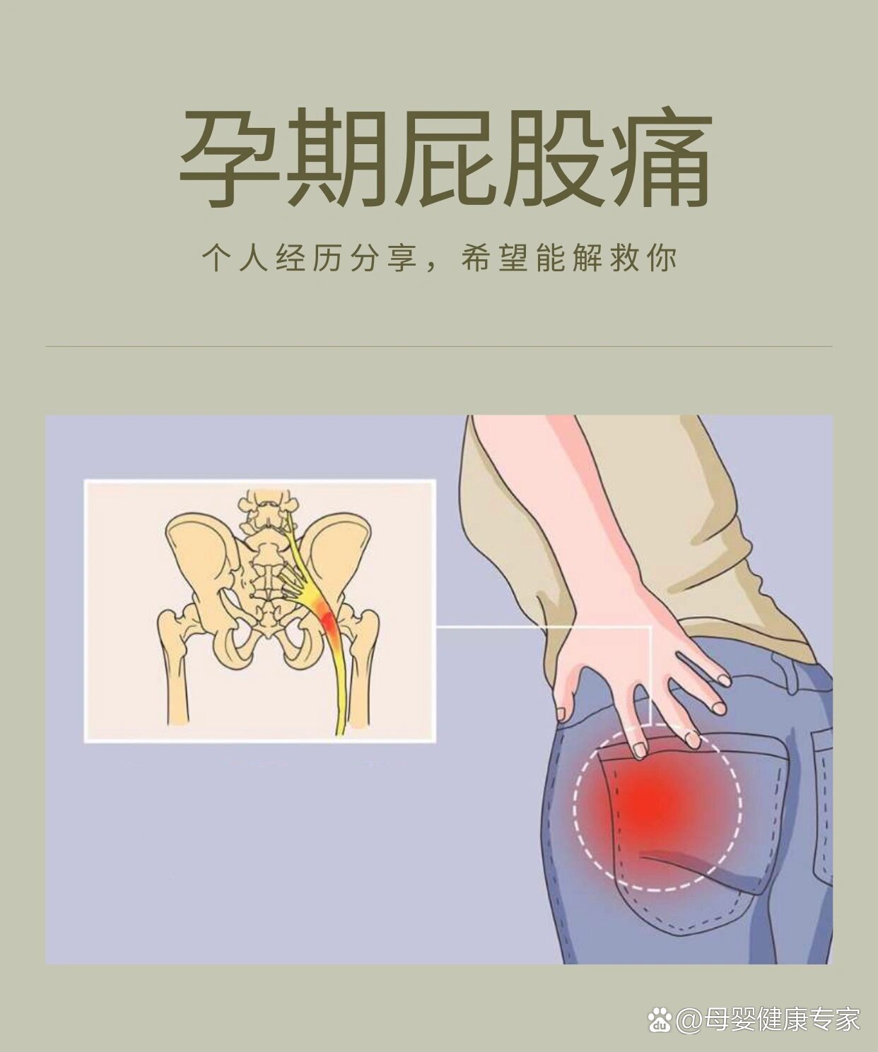 孕期屁股痛|坐骨神经痛缓解办法
