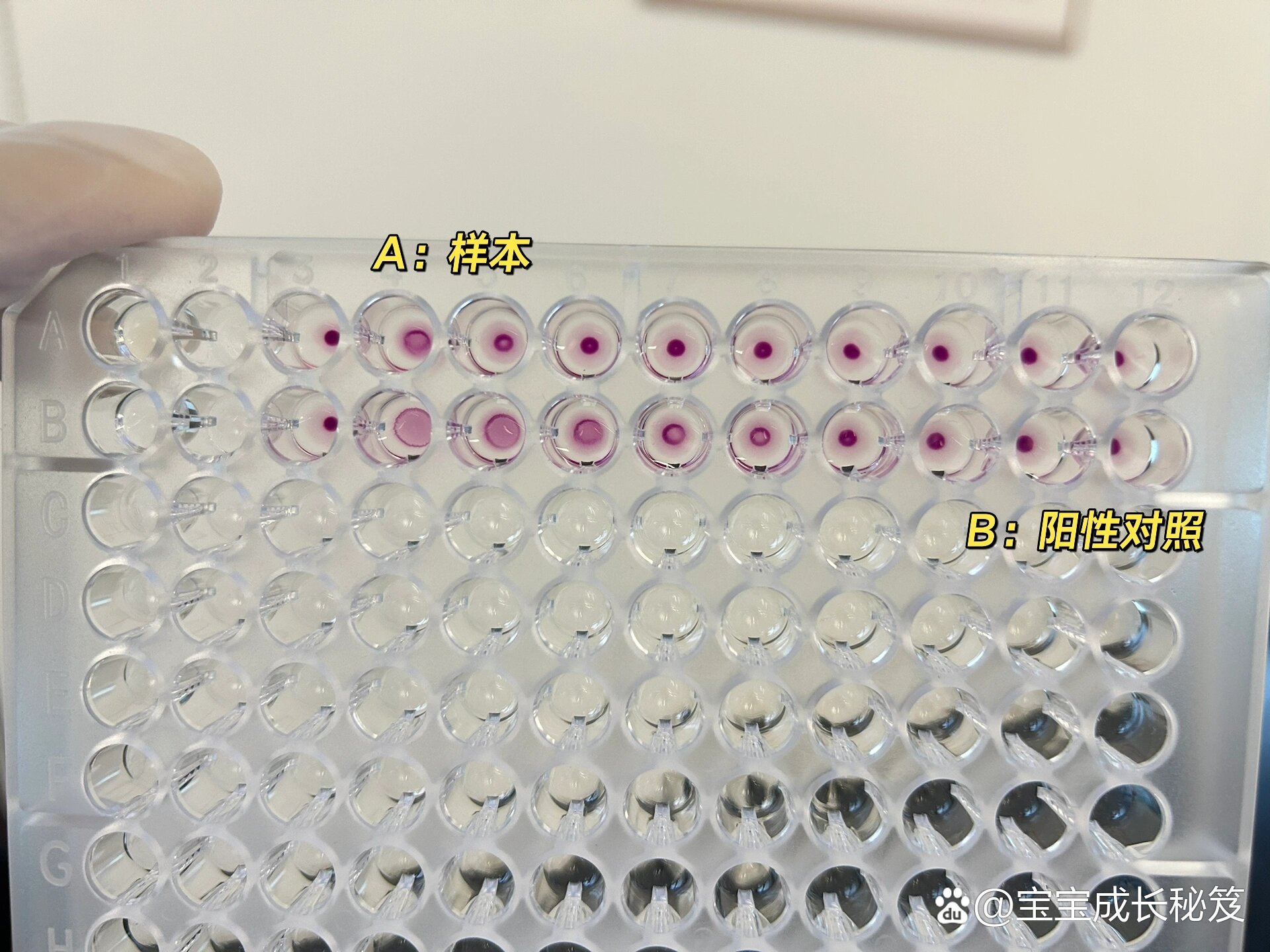  p>检验人 | tppa判定和假阳性 br>隐性梅毒诊断依据为: br>(1)符合