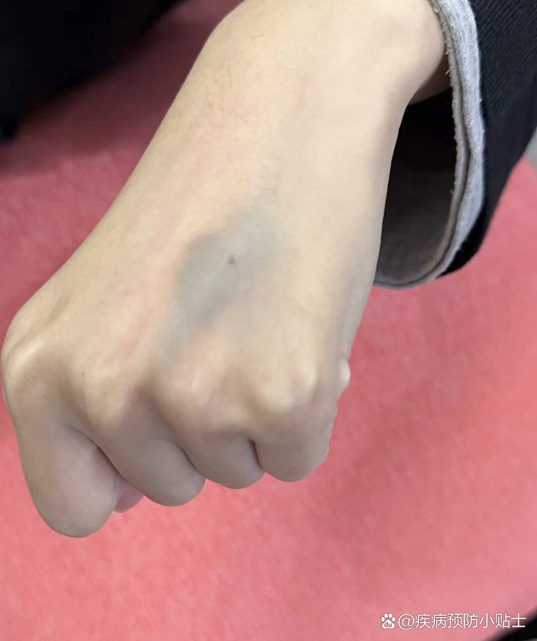 输液后血管鼓包